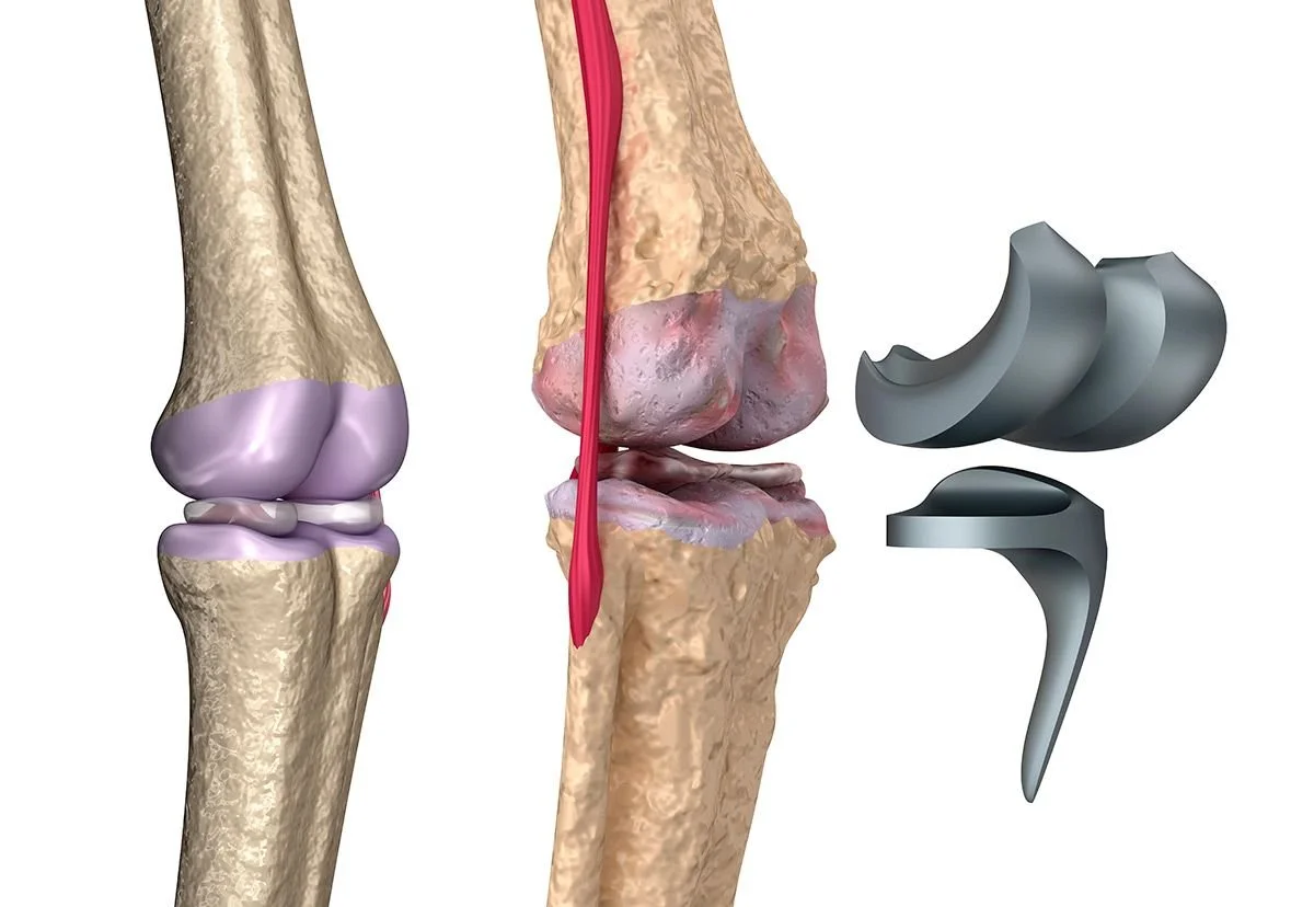 Prótesis de rodilla y cadera