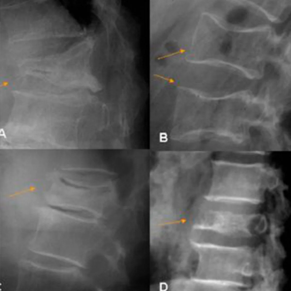 Fracturas de columna