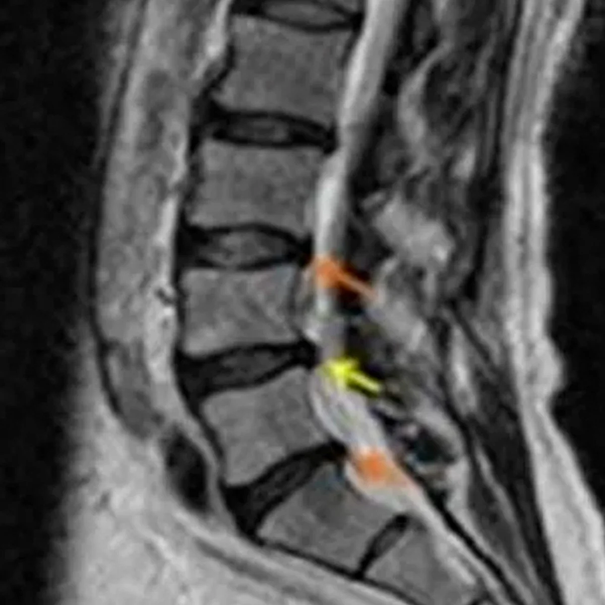 Hernias de disco