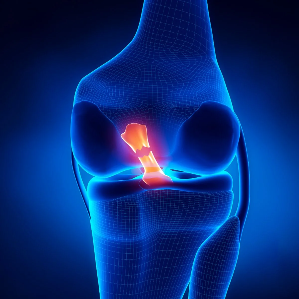 Lesiones de ligamentos de rodilla