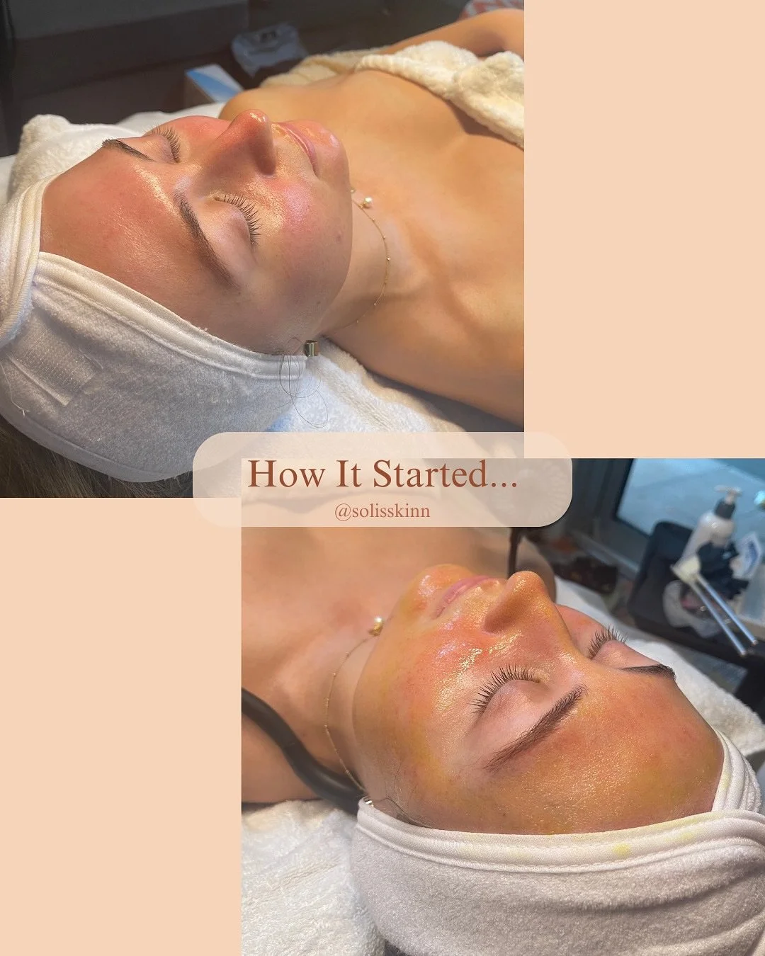 4 sessions of BioRePeel, with the final session incorporating an advanced microneedling modality&mdash;and just like that, we&rsquo;ve regenerated skin! ✨

My client initially presented with inflamed skin, enlarged pores, an oily T-zone, and persiste
