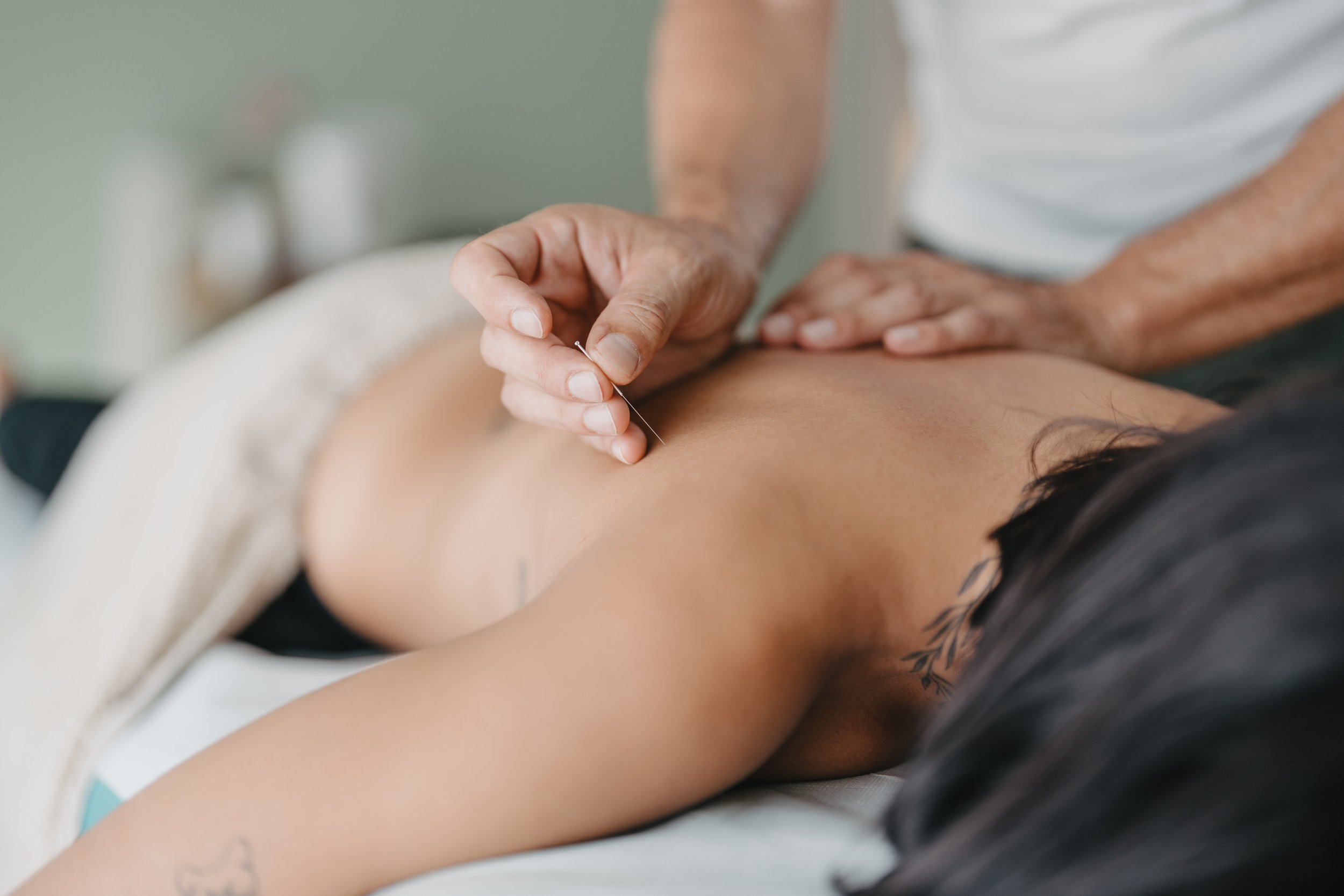 Person receiving acupuncture treatment on back in a clinical setting