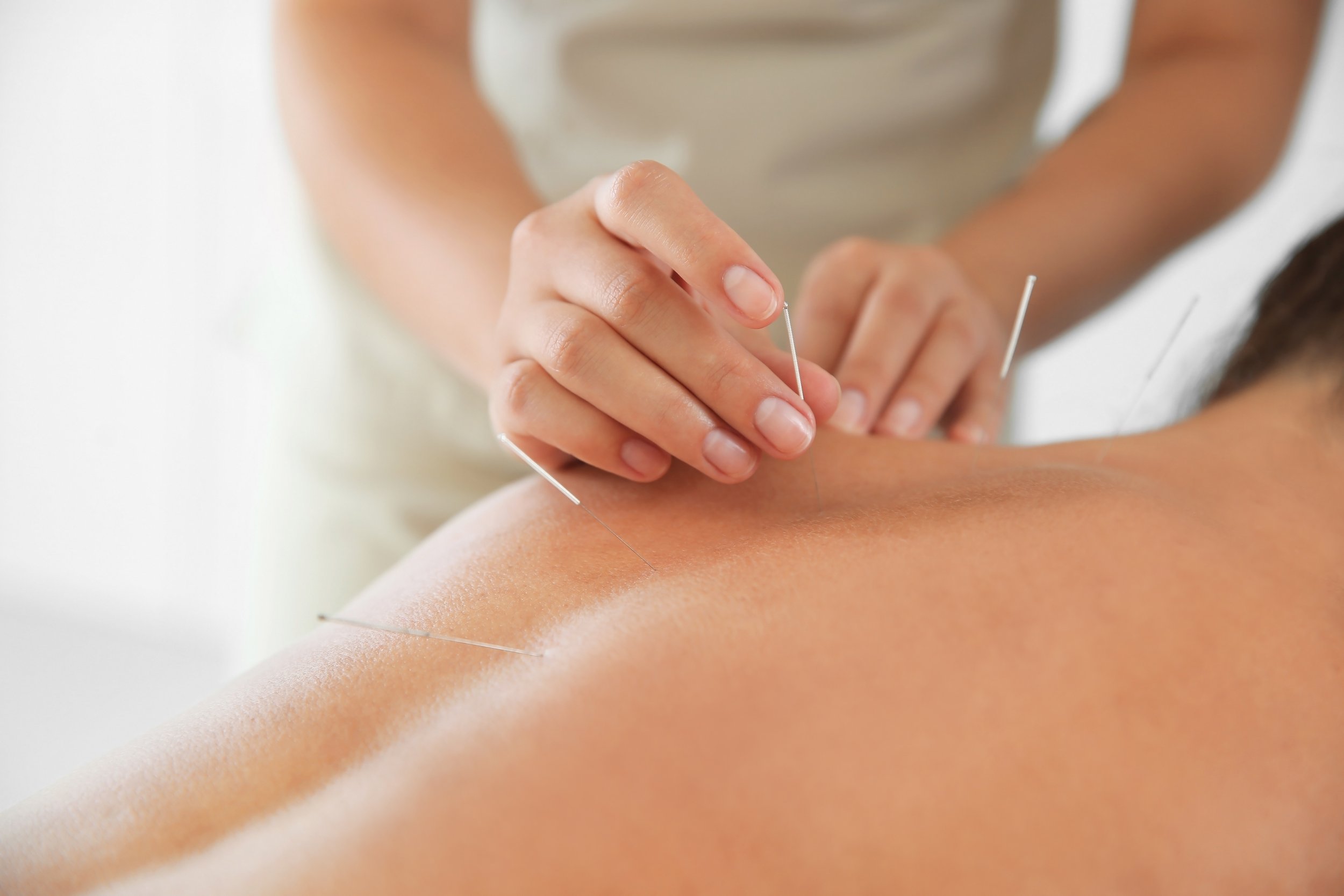 Person receiving acupuncture treatment on their back with multiple acupuncture needles.