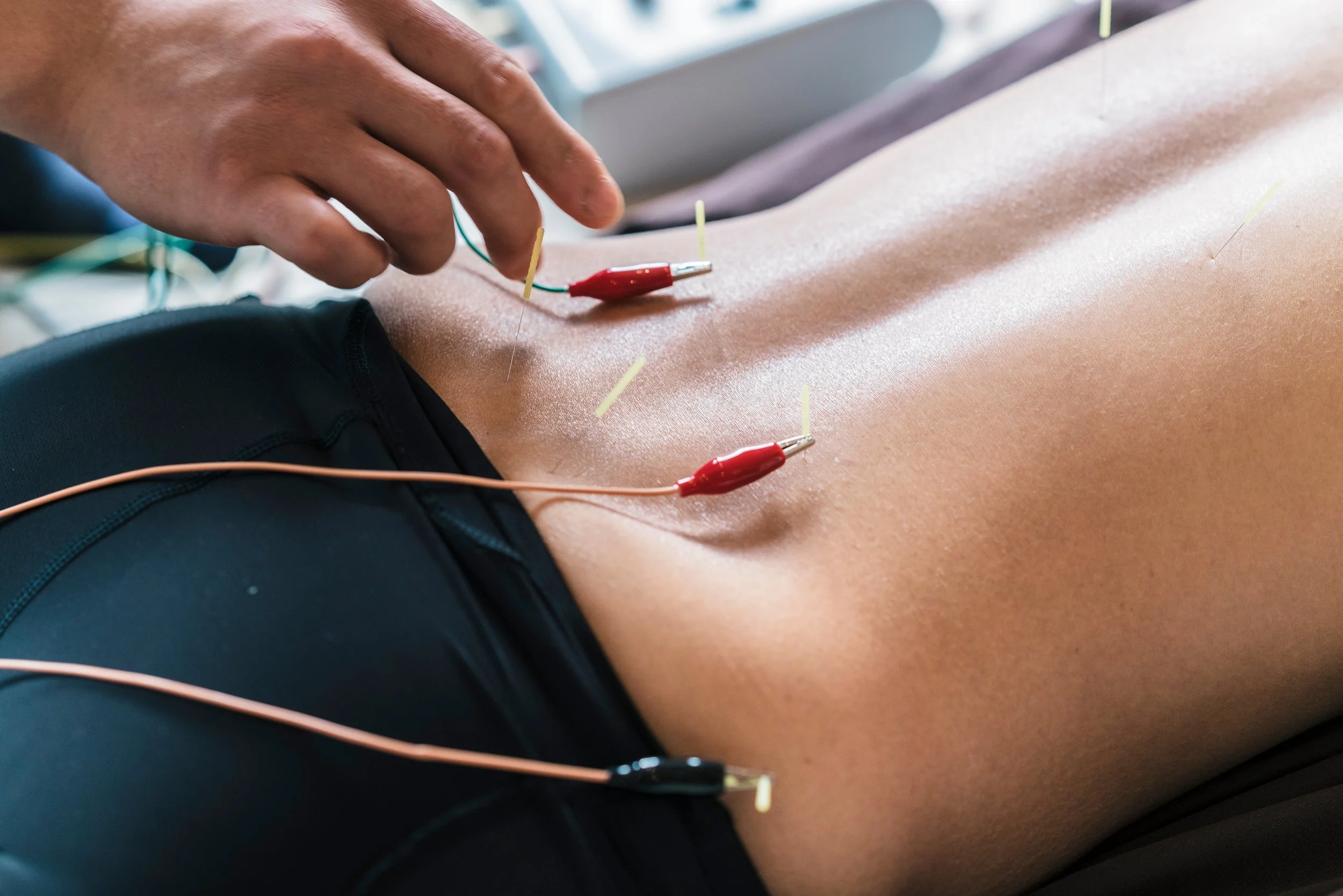 Person undergoing acupuncture treatment with multiple acupuncture needles inserted into their abdomen and electrotherapy electrodes attached.