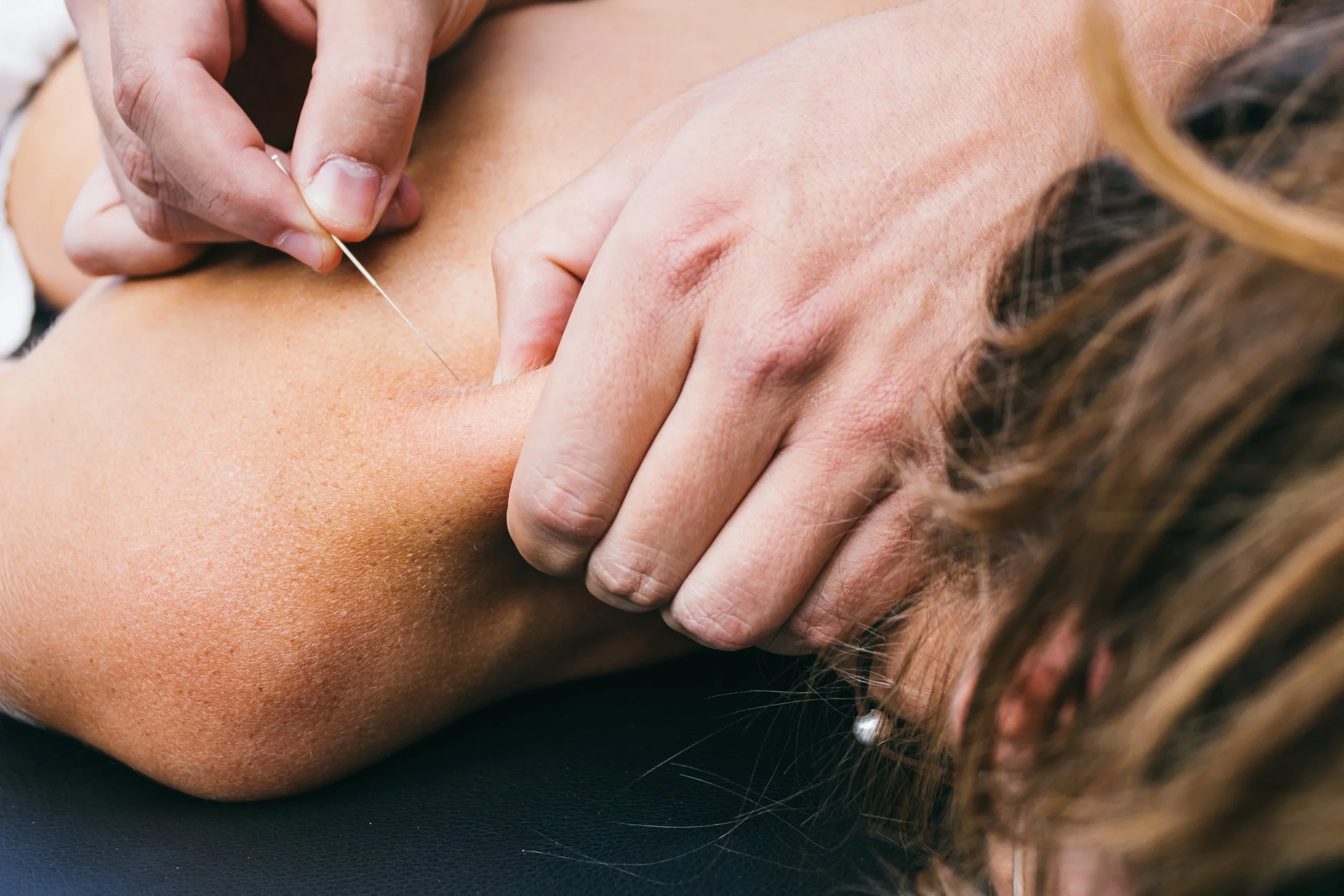 Person receiving acupuncture with needle inserted into their back.