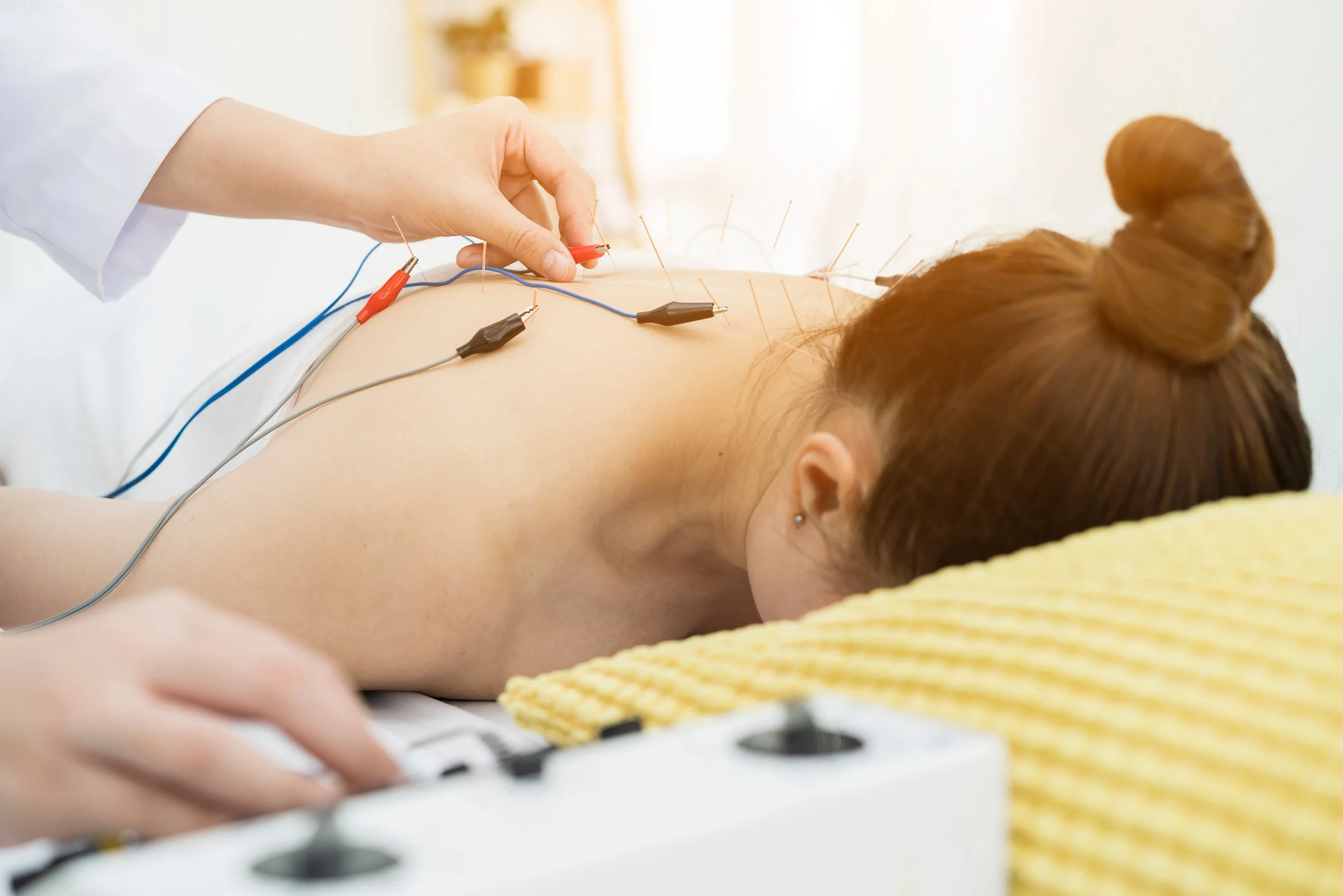 A woman lying face down receiving acupuncture treatment on her back. Multiple acupuncture needles are inserted into her back, and wires with clips are attached to the needles, connecting to an electronic device.