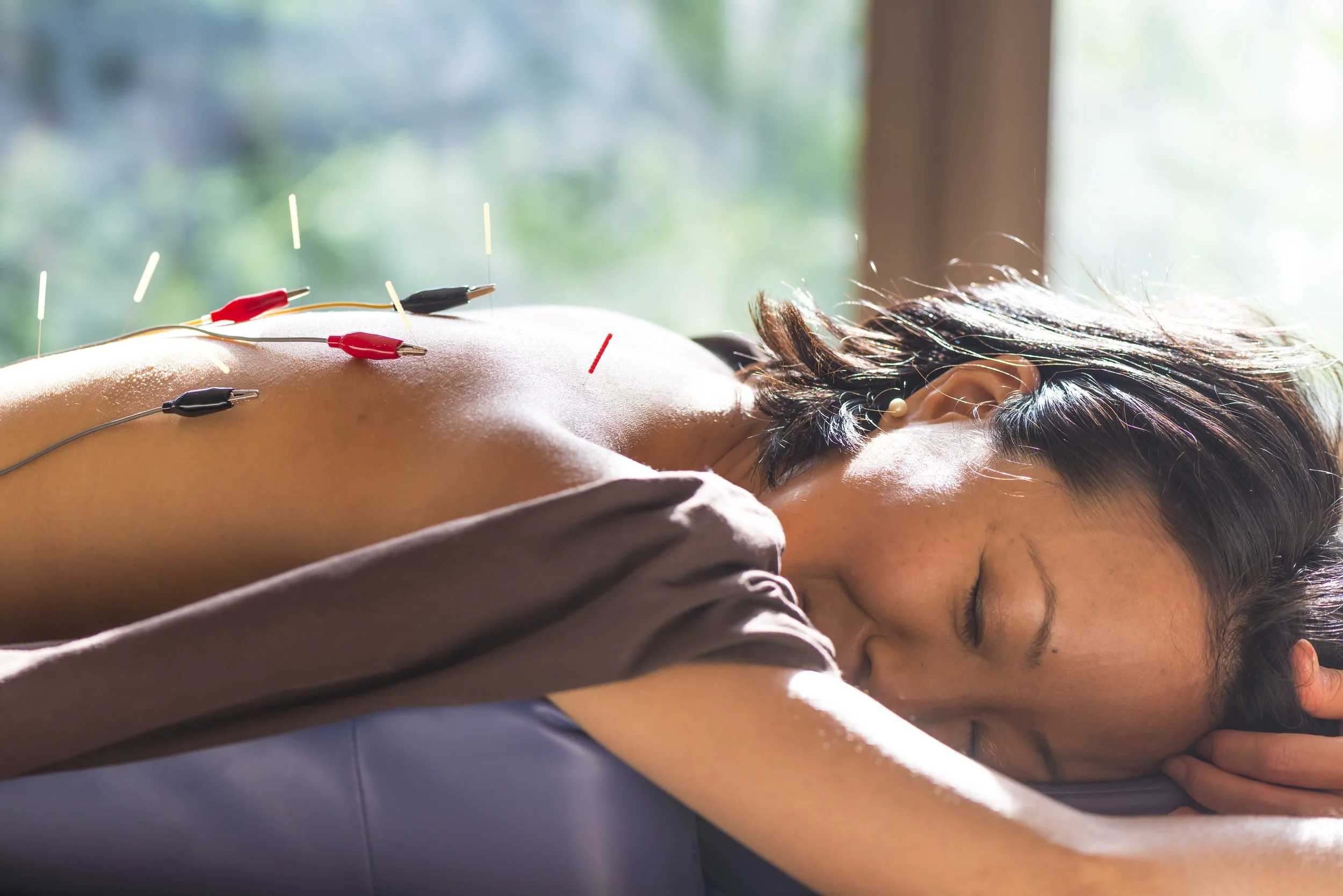 A woman receiving acupuncture treatment, lying face down with needles inserted into her back, in a well-lit room with a window in the background.