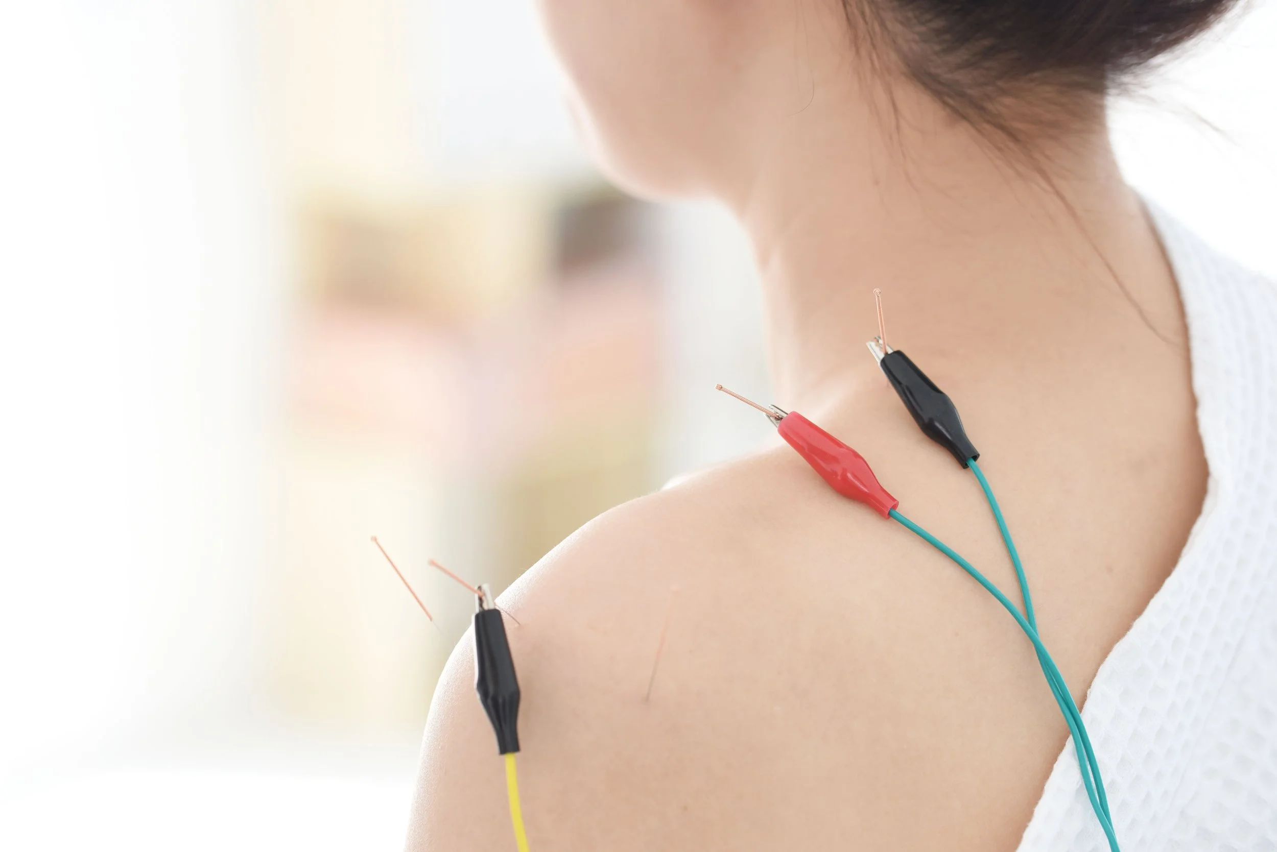 Person receiving acupuncture treatment on shoulder and neck