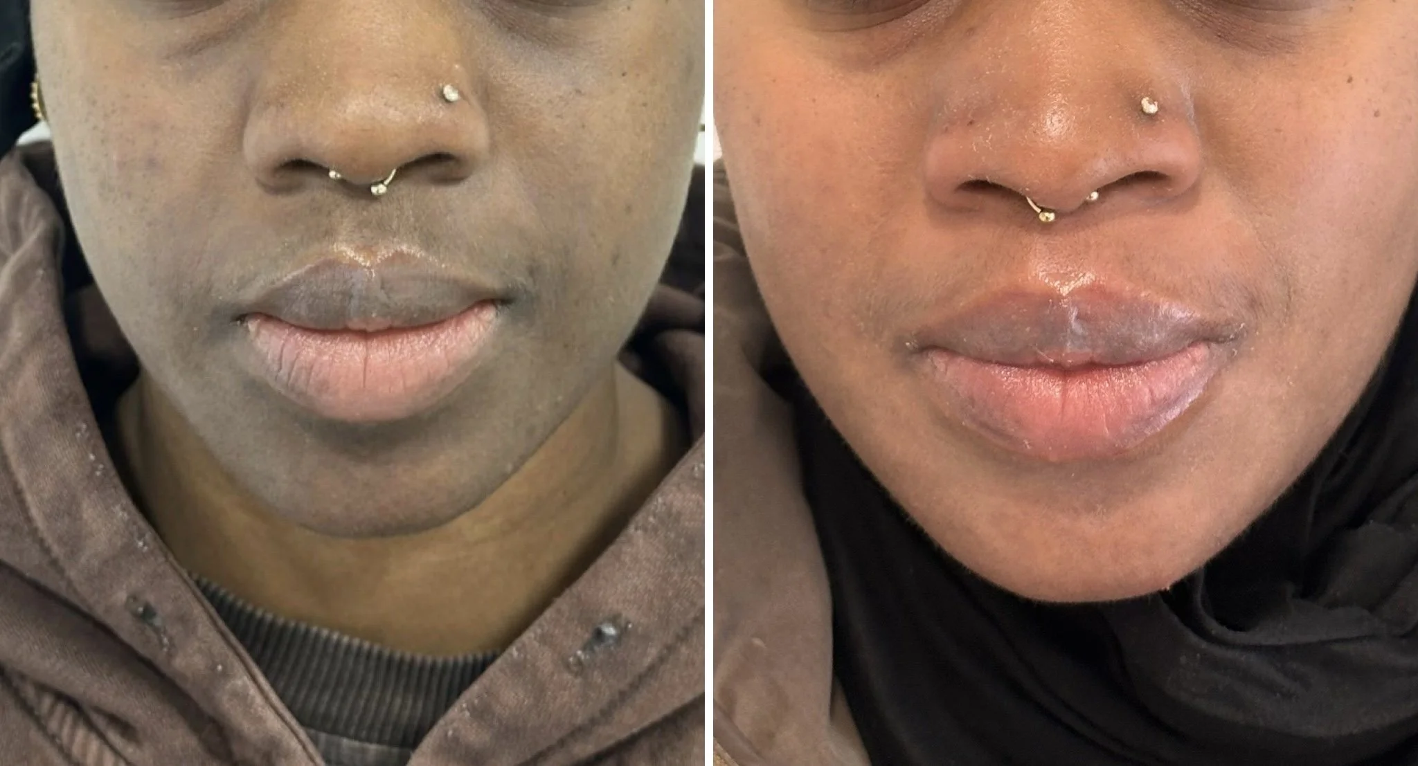  Why I Recommend Cosmelan® for Stubborn Pigmentation in Deeper Skin Tones