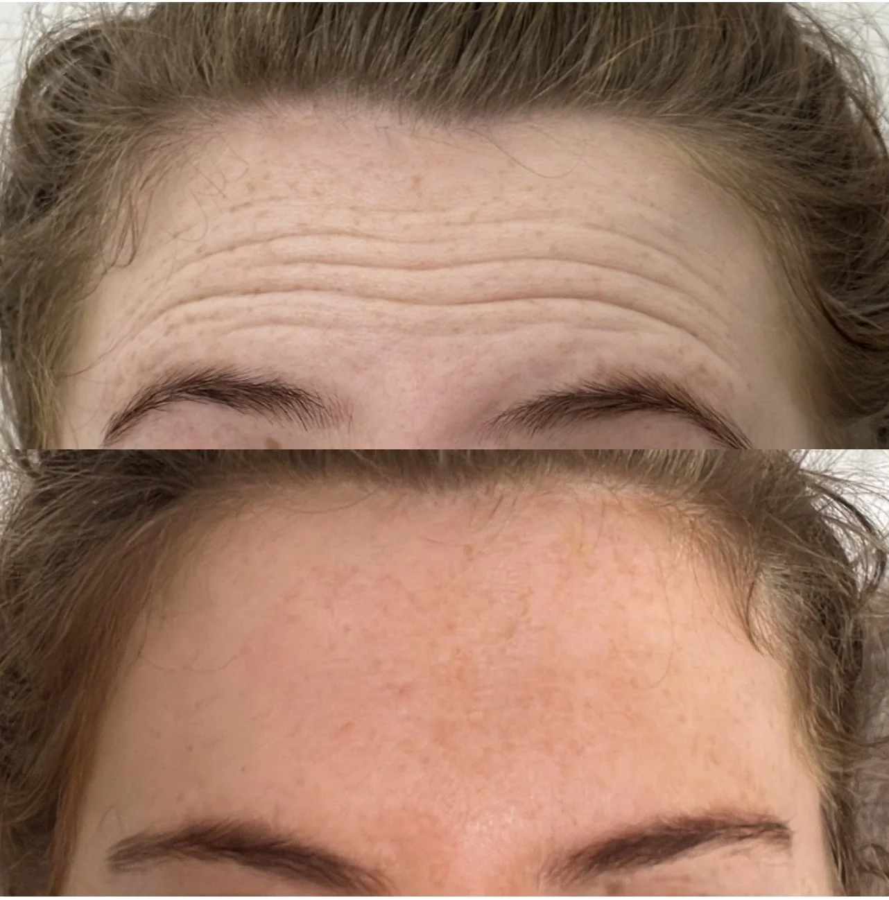 Anti Wrinkle treatment before and after