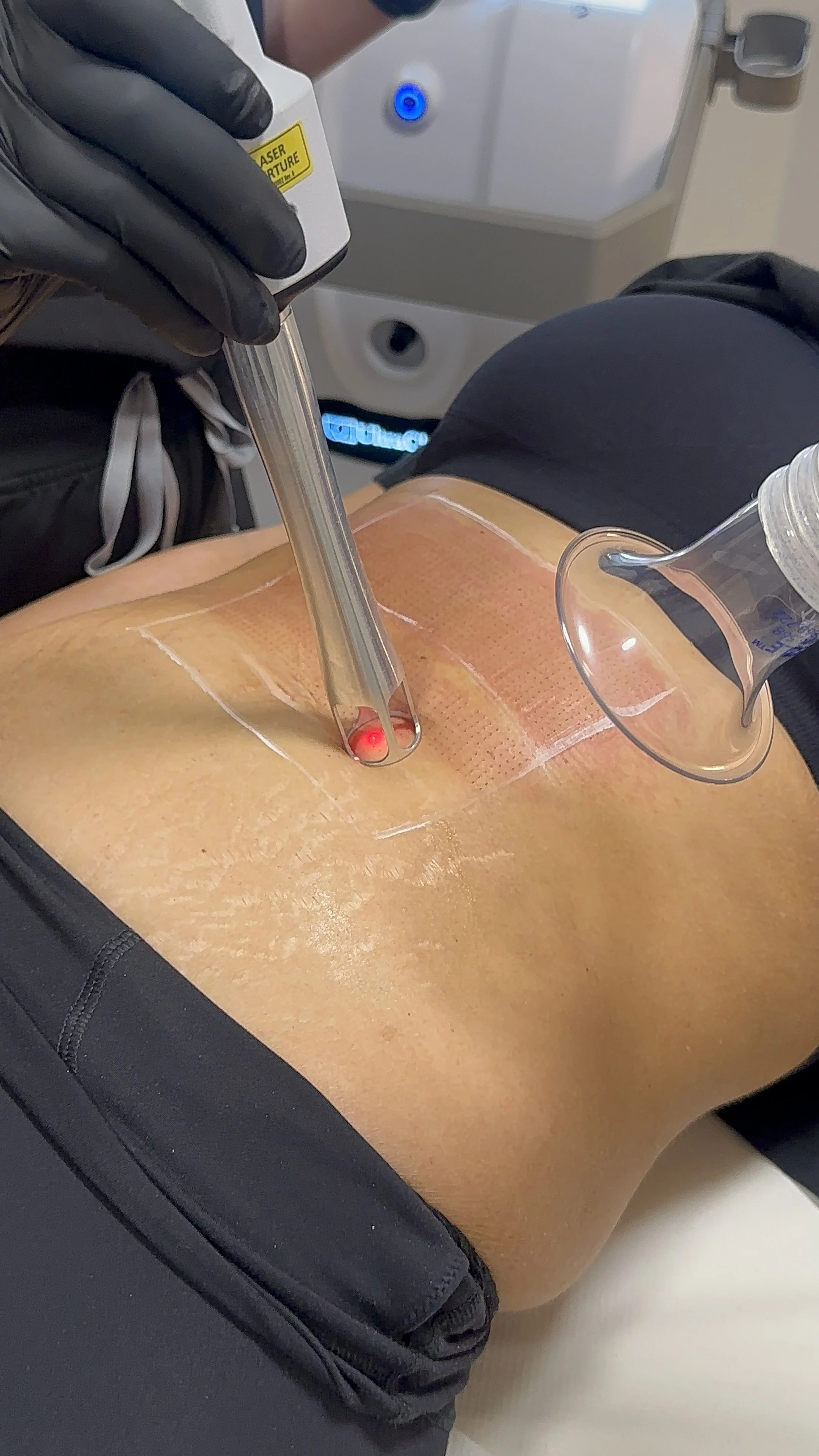 skin tightening treatment at The York Skin Clinic