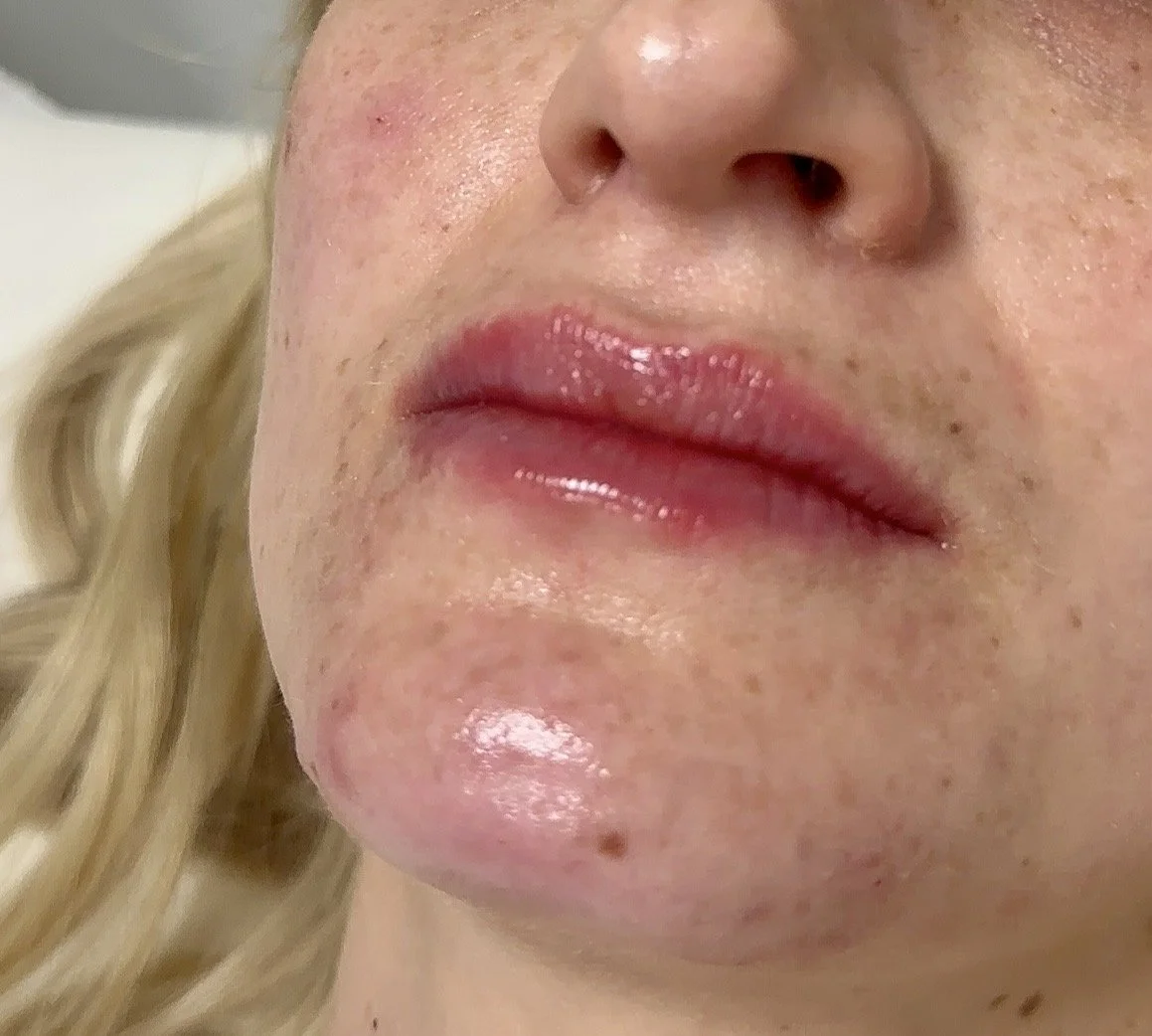 Lip filler treatment 