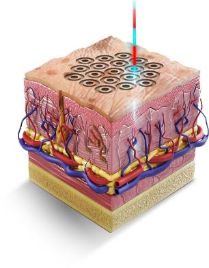 High-Resolution-Skin-Resurfacing.webp