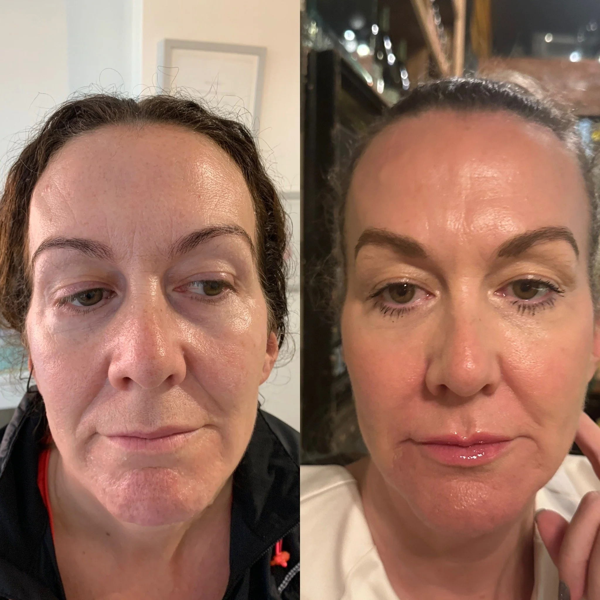 Dermal filler before and after