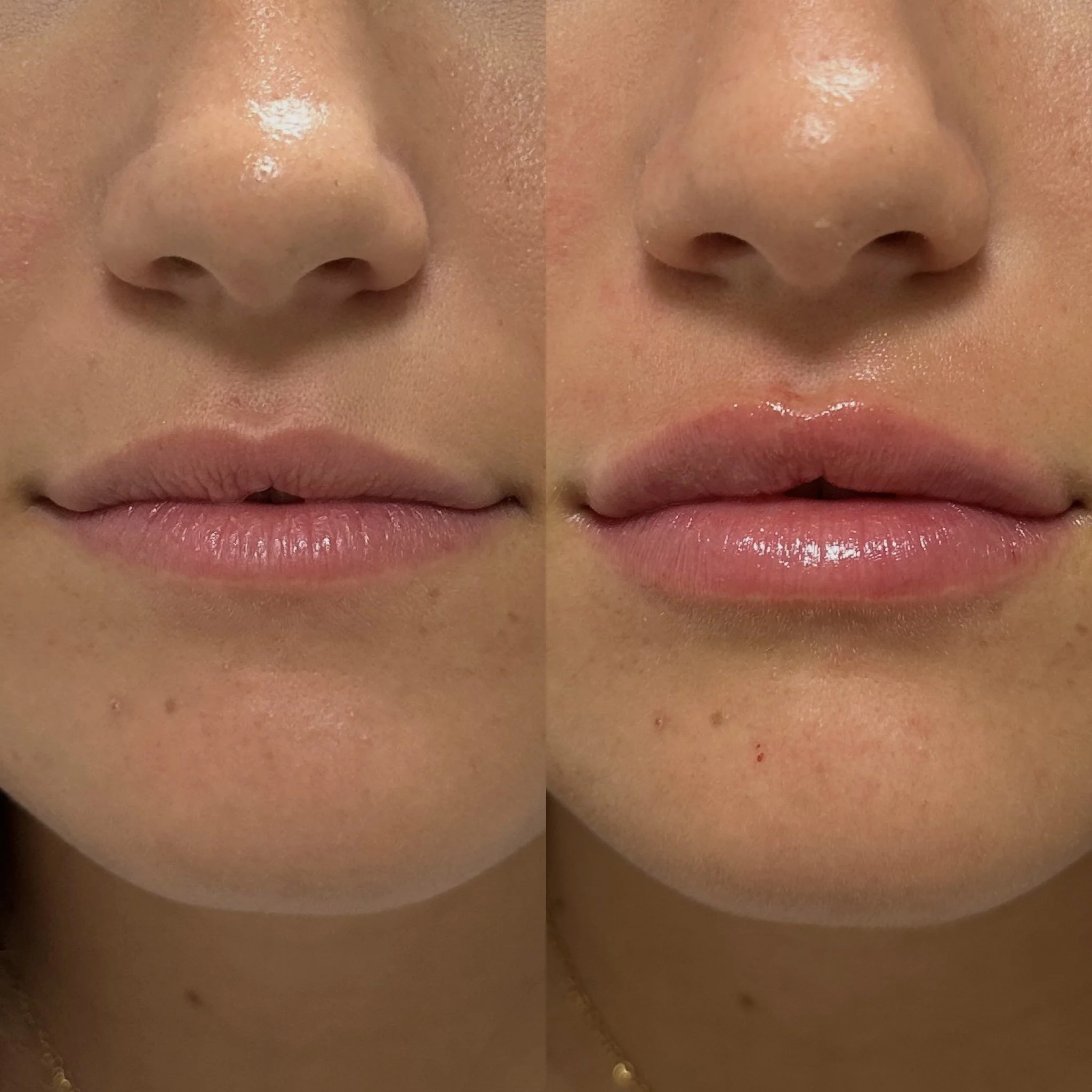 Lip filler before and after