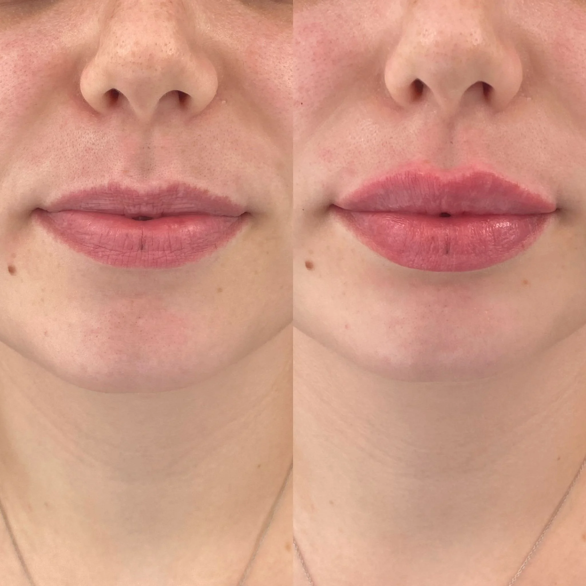 Lip filler before and after