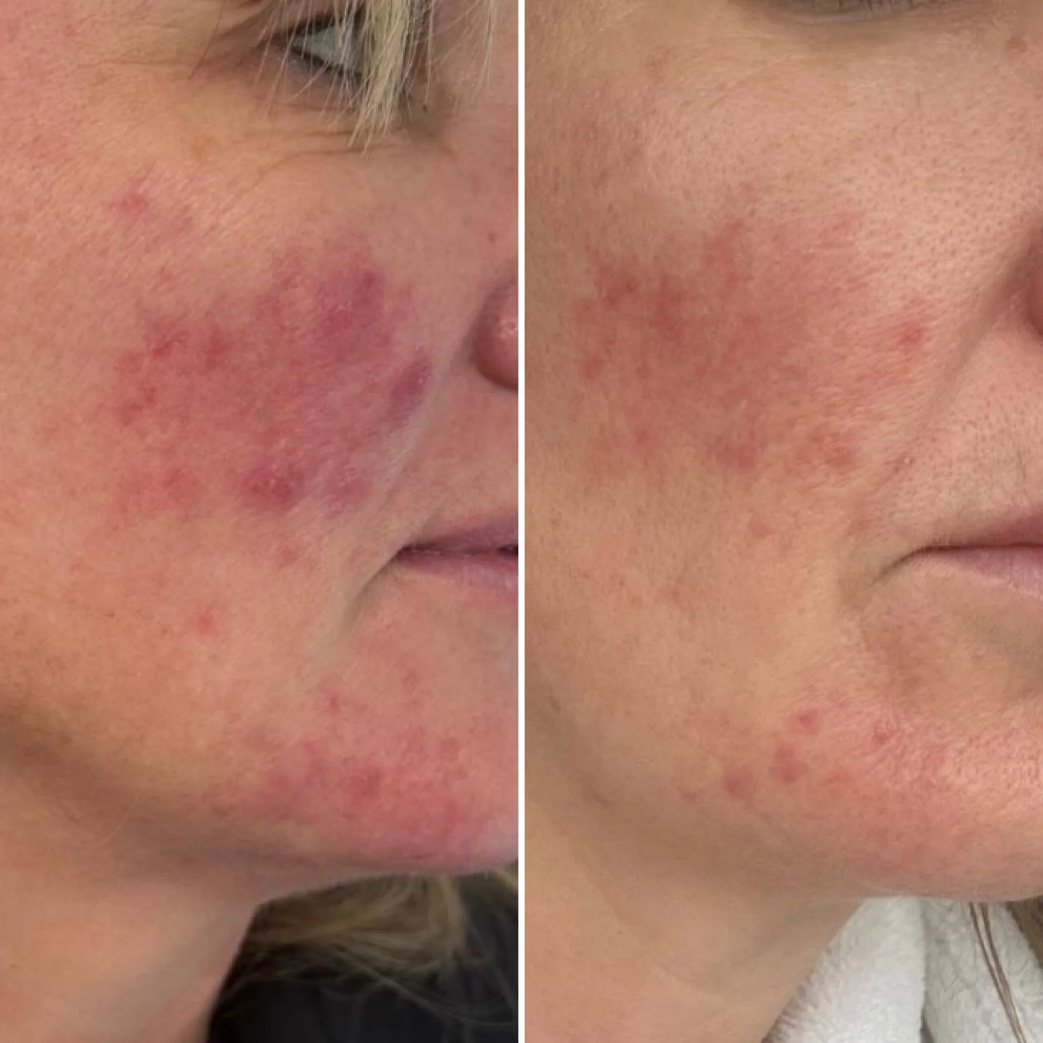 Facial rosacea treatment results showing a significant reduction in redness and vascular inflammation at The York Skin Clinic.