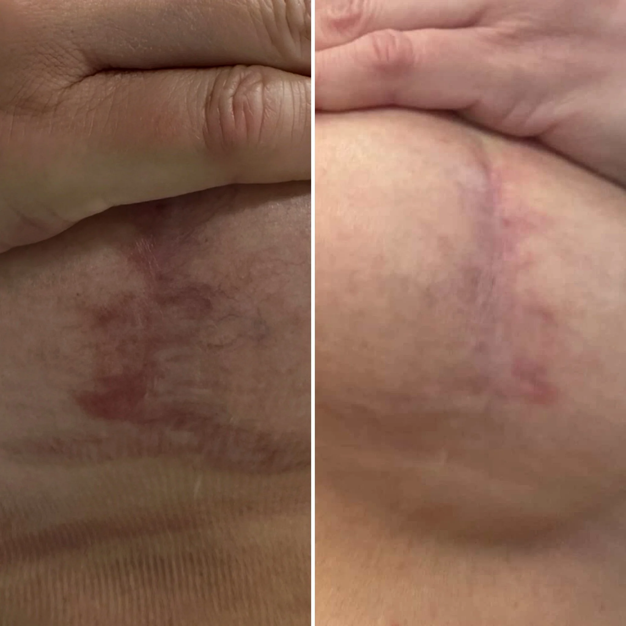 Surgical scar revision before and after following UltraClear laser resurfacing to improve skin texture and flatten scar tissue in York.