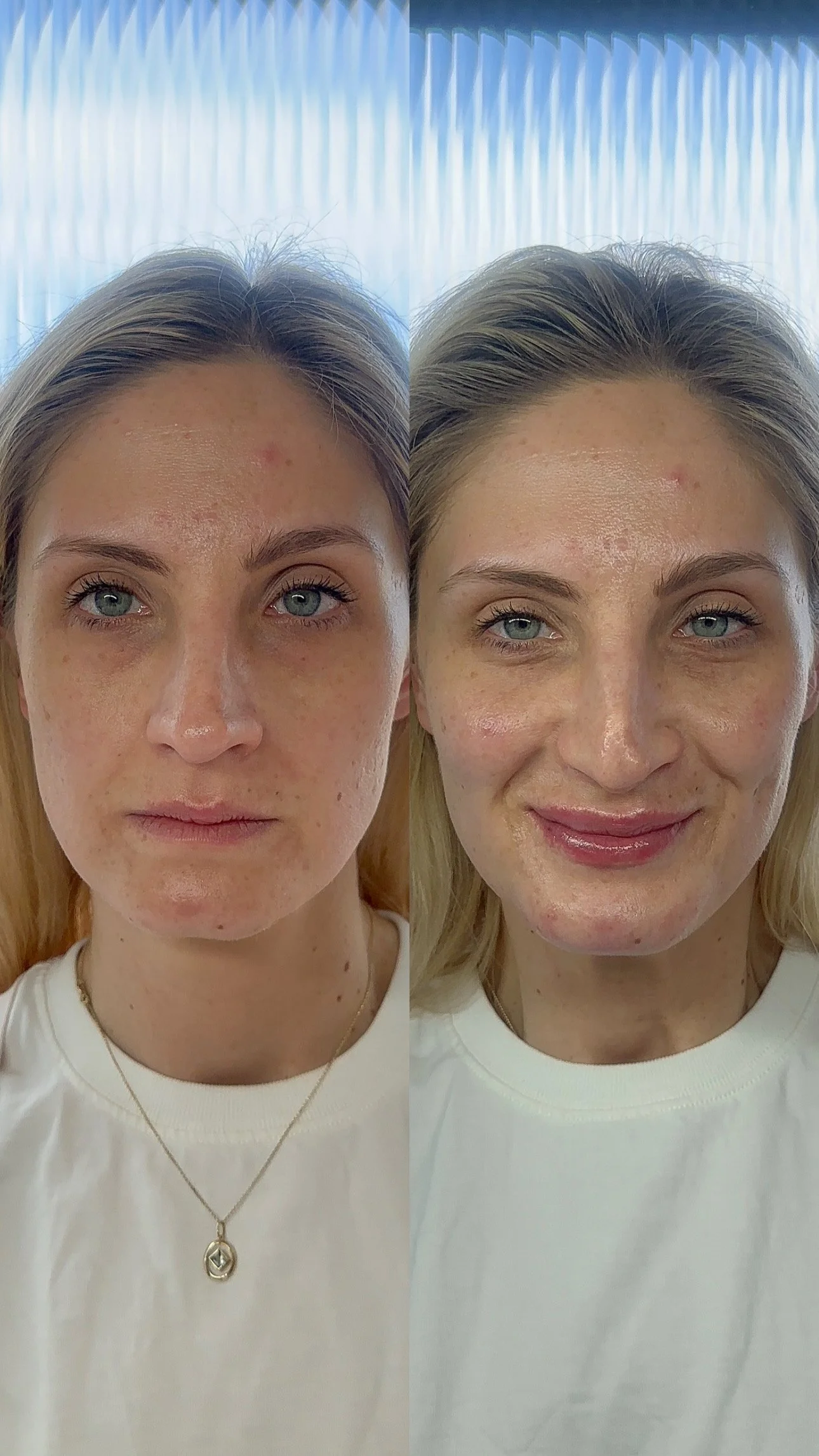 Side-by-side comparison of a woman's face before and after dermal filler treatment 