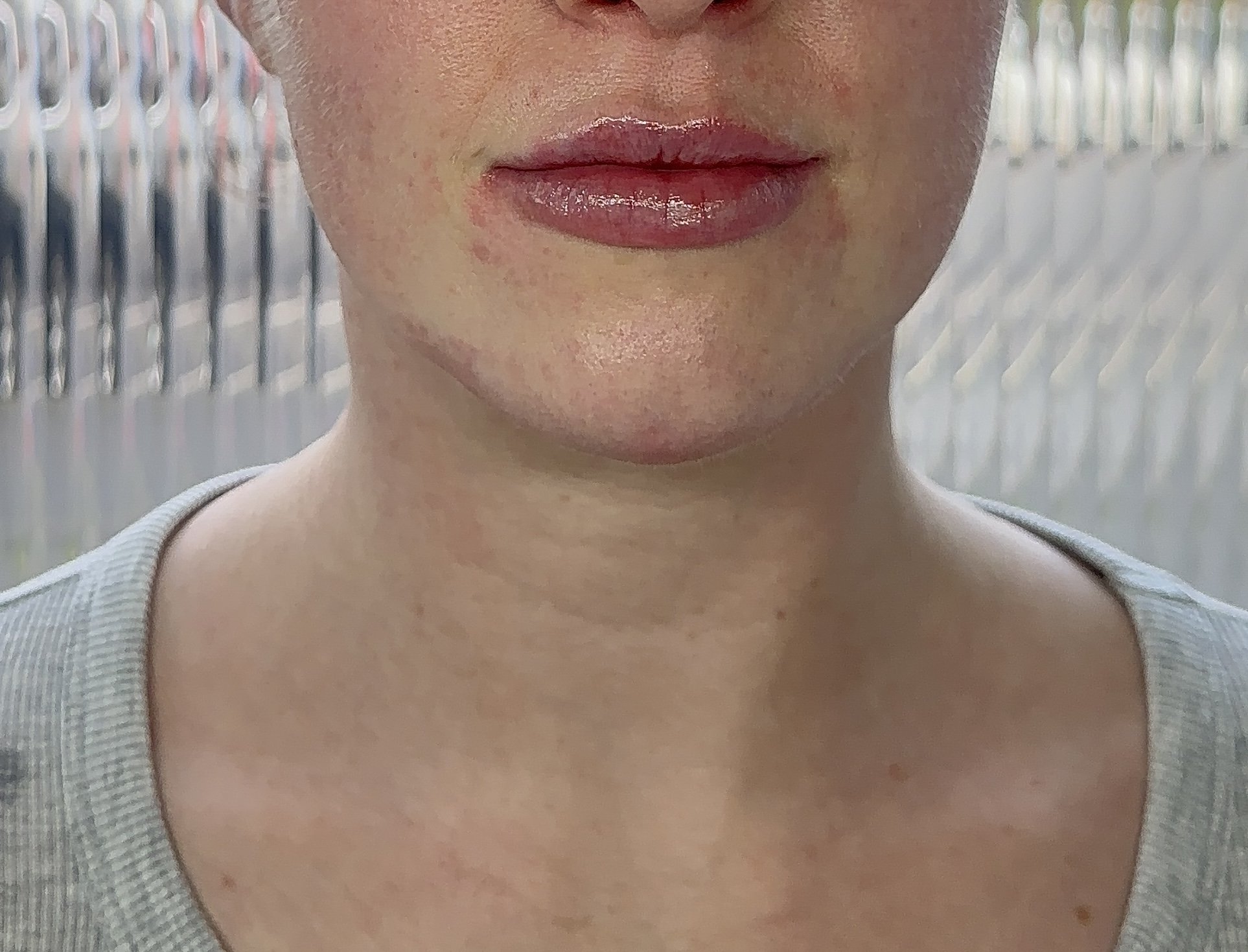 Natural dermal filler result