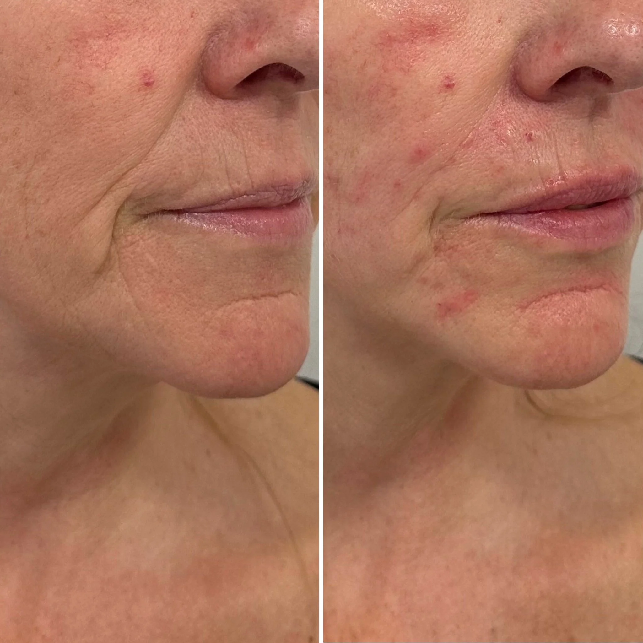 Close-up comparison of a woman's cheek and mouth before and after skin treatment, showing reduced wrinkles and improved skin texture.
