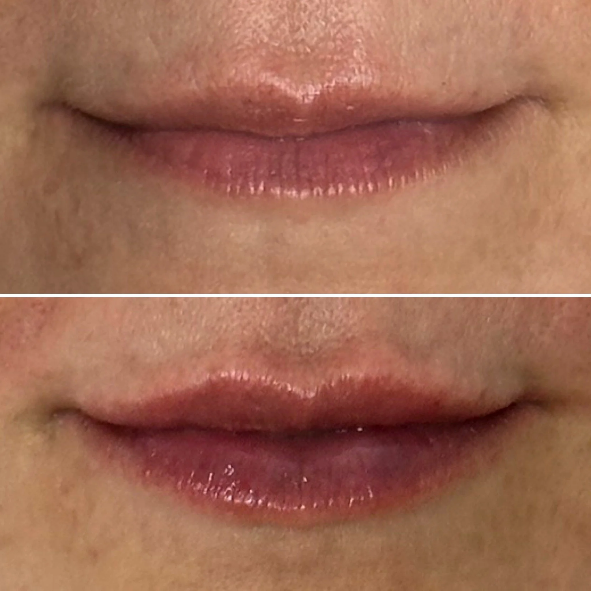 Lip filler before and after