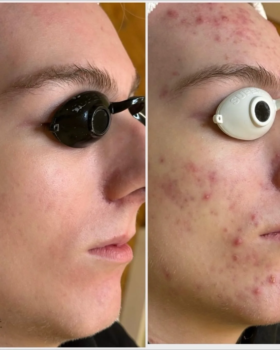 Seeing progress like this never gets old! Thank you for trusting me with your skin😁#facerealityskincare #facerealityacnespecialist #acnebootcamp #allybaesthetics #humboldtparkchicago