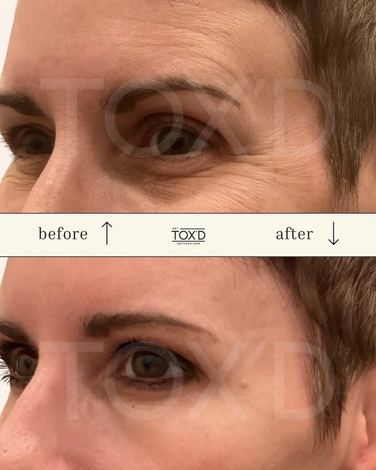 Crow's feet before and after Botox at Get Tox'd