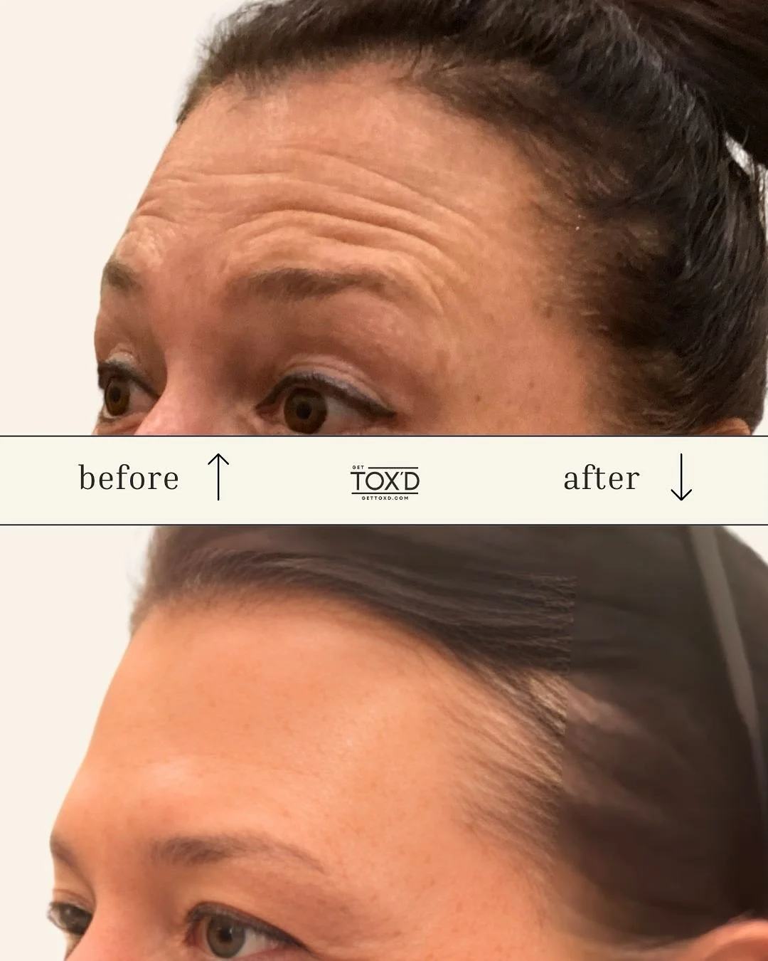Smooth, natural, refreshed, that&rsquo;s the magic of expertly placed forehead tox ✨

In just a few days, expression lines soften, skin looks rejuvenated, and your confidence takes center stage. No filters. Just beautifully balanced results tailored 