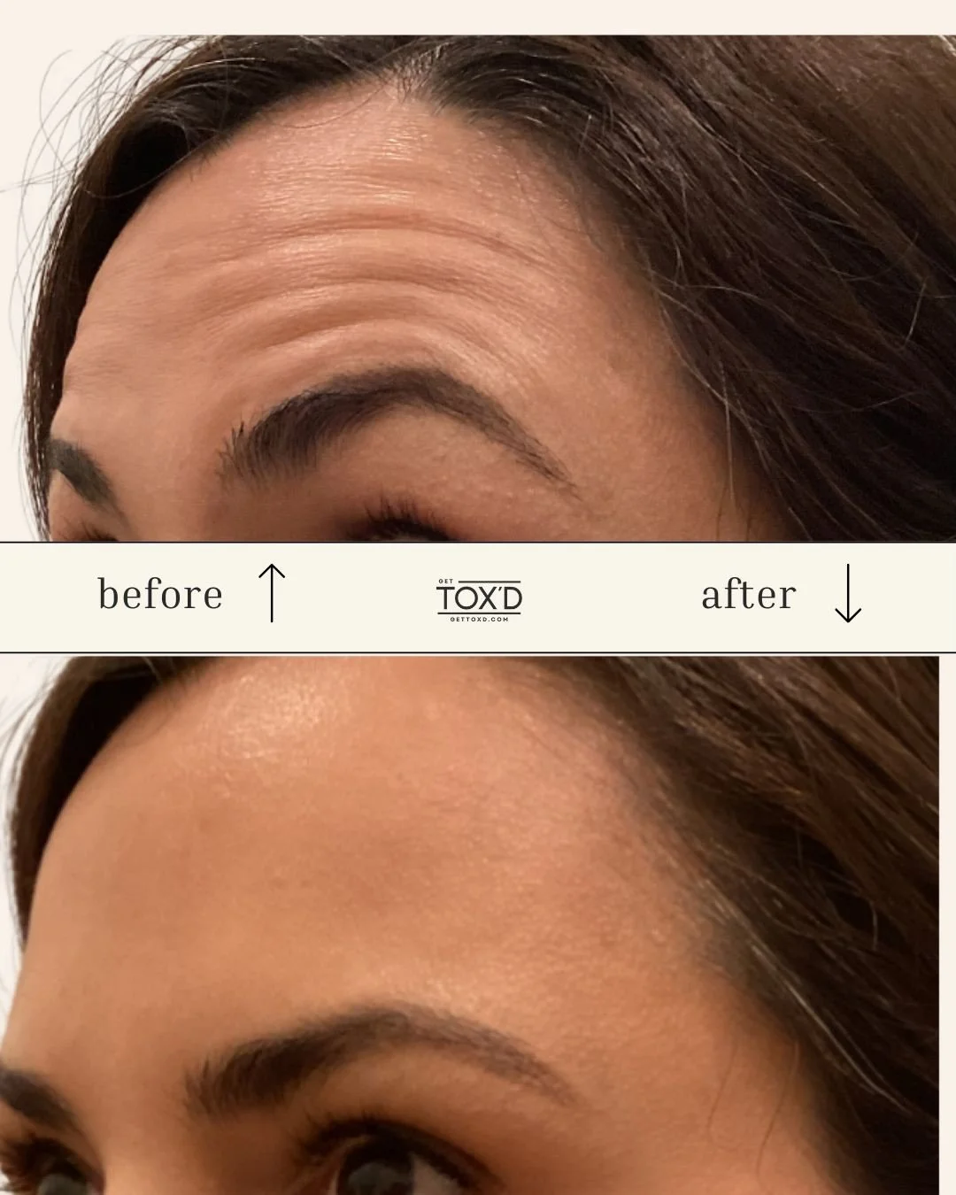 Forehead lines? Handled. 🤭

This glow-up shows just how powerful precise tox placement can be, smoother skin, softer lines, and a natural look that still feels like you. ✨

Ready to refresh your look with subtle, confidence-boosting results? Your sk