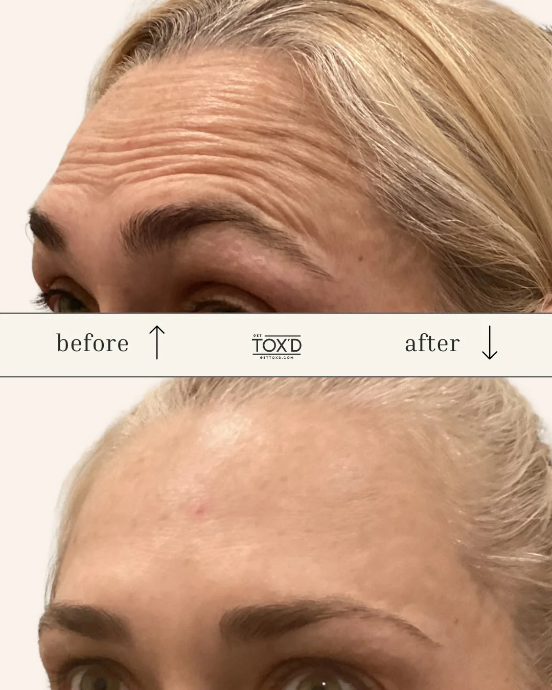 ✨ Real results, zero surprises ✨
💉Before &amp; after photos tell the story: Tox softens movement, smooths lines, and keeps your expression looking natural.
Here&rsquo;s why these changes happen:
&bull; Neurotoxins relax the muscles that create wrink