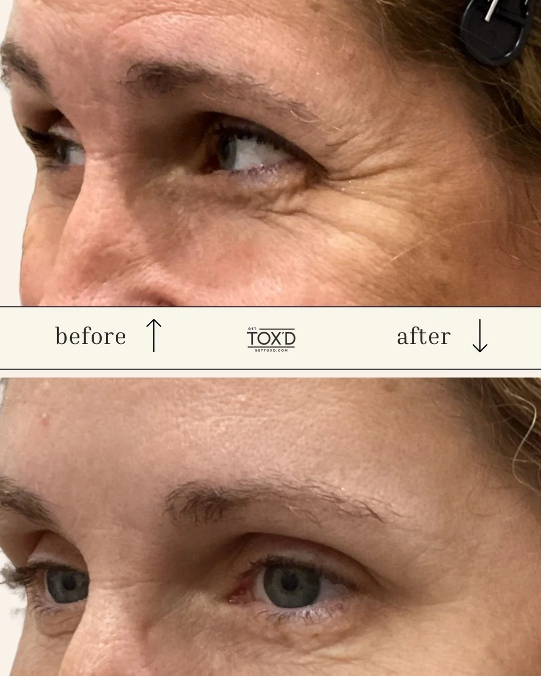 Smooth. Refreshed. Effortless. ✨

These before-and-afters are your reminder that a little Tox can make a big difference, while still keeping everything looking naturally you.

From softening crow&rsquo;s feet to relaxing forehead lines, our treatment