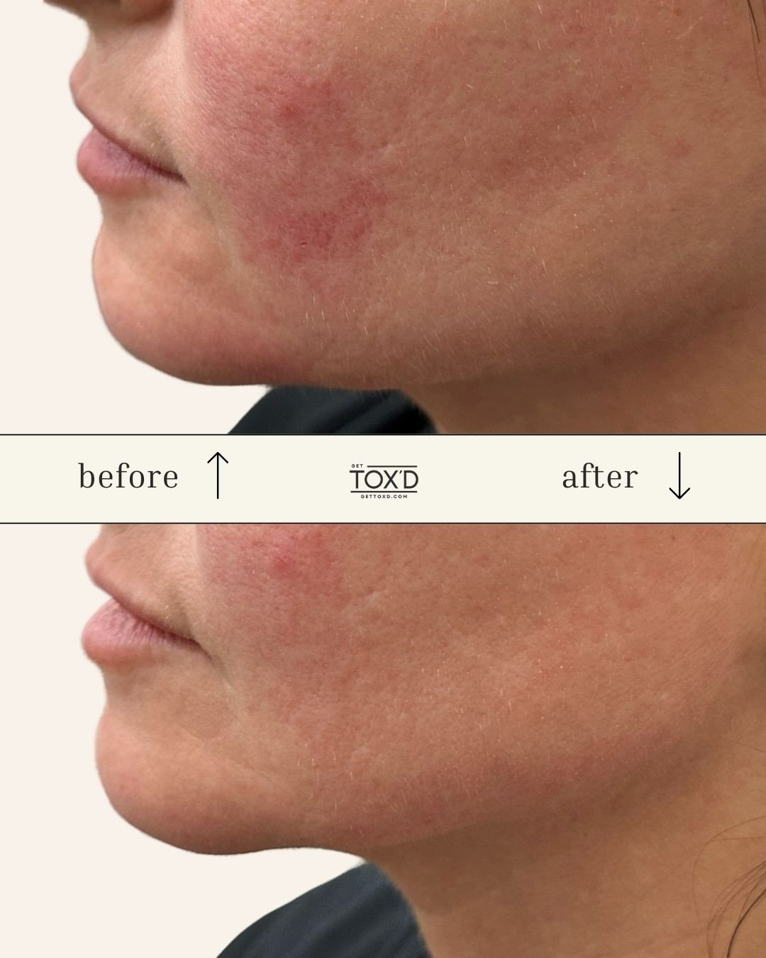 There&rsquo;s nothing like a good Before &amp; After to show how small, precise enhancements can make all the difference. 

Our expert injectors focus on balanced, refreshed outcomes, never overdone, always YOU.

Whether you&rsquo;re looking to softe