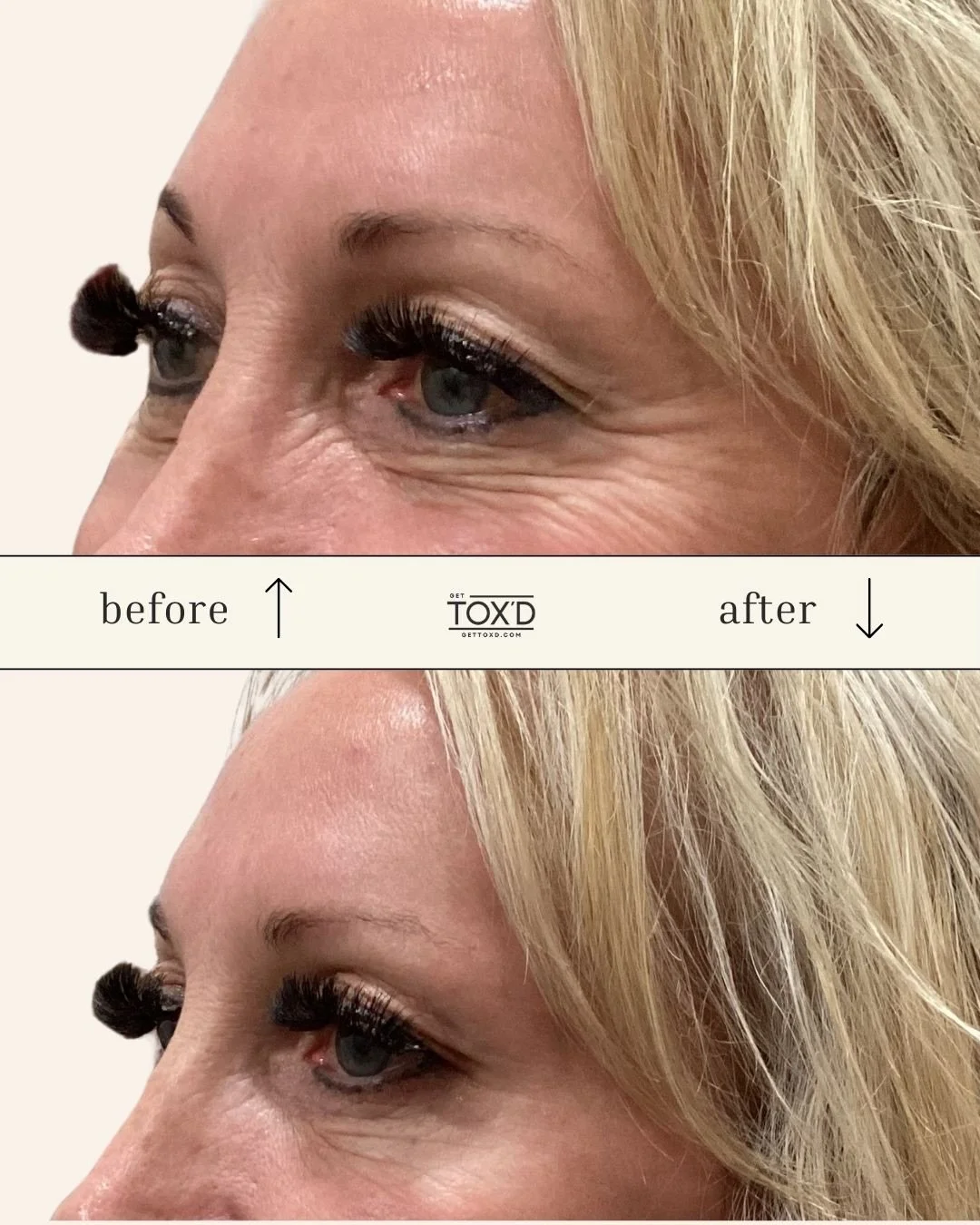 Forehead lines &rarr; smoother, refreshed skin ✨💉 

This real before &amp; after shows how strategic forehead Botox can soften wrinkles, enhance skin texture, and keep your expressions natural 😍 

At Get Tox&rsquo;d, we&rsquo;re all about subtle re