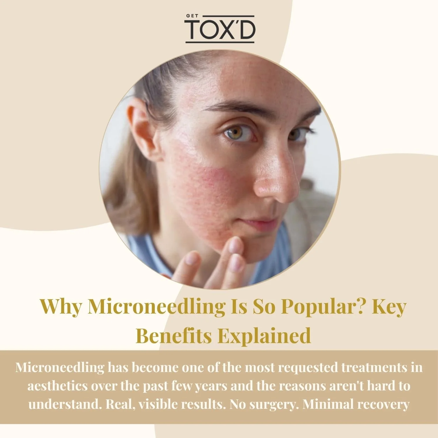 Why Microneedling Is So Popular? Key Benefits Explained