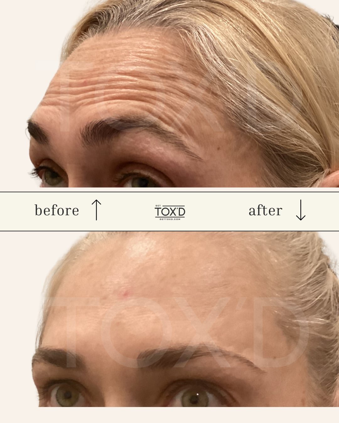 Real botox results: forehead wrinkle reduction at Tox’d
