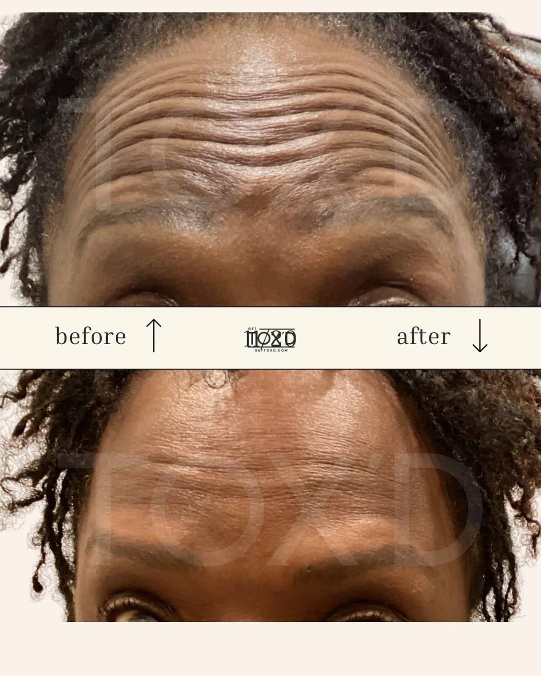Tox’d botox results: smoother forehead in real client photo