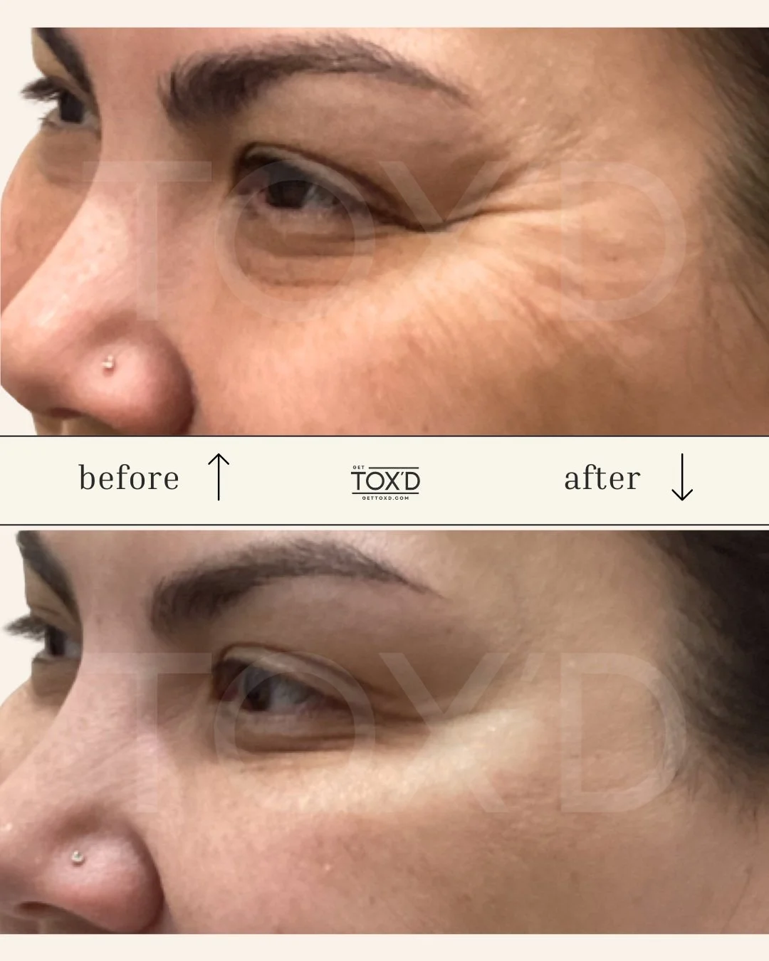 Tox’d client showing botox results for crow’s feet area