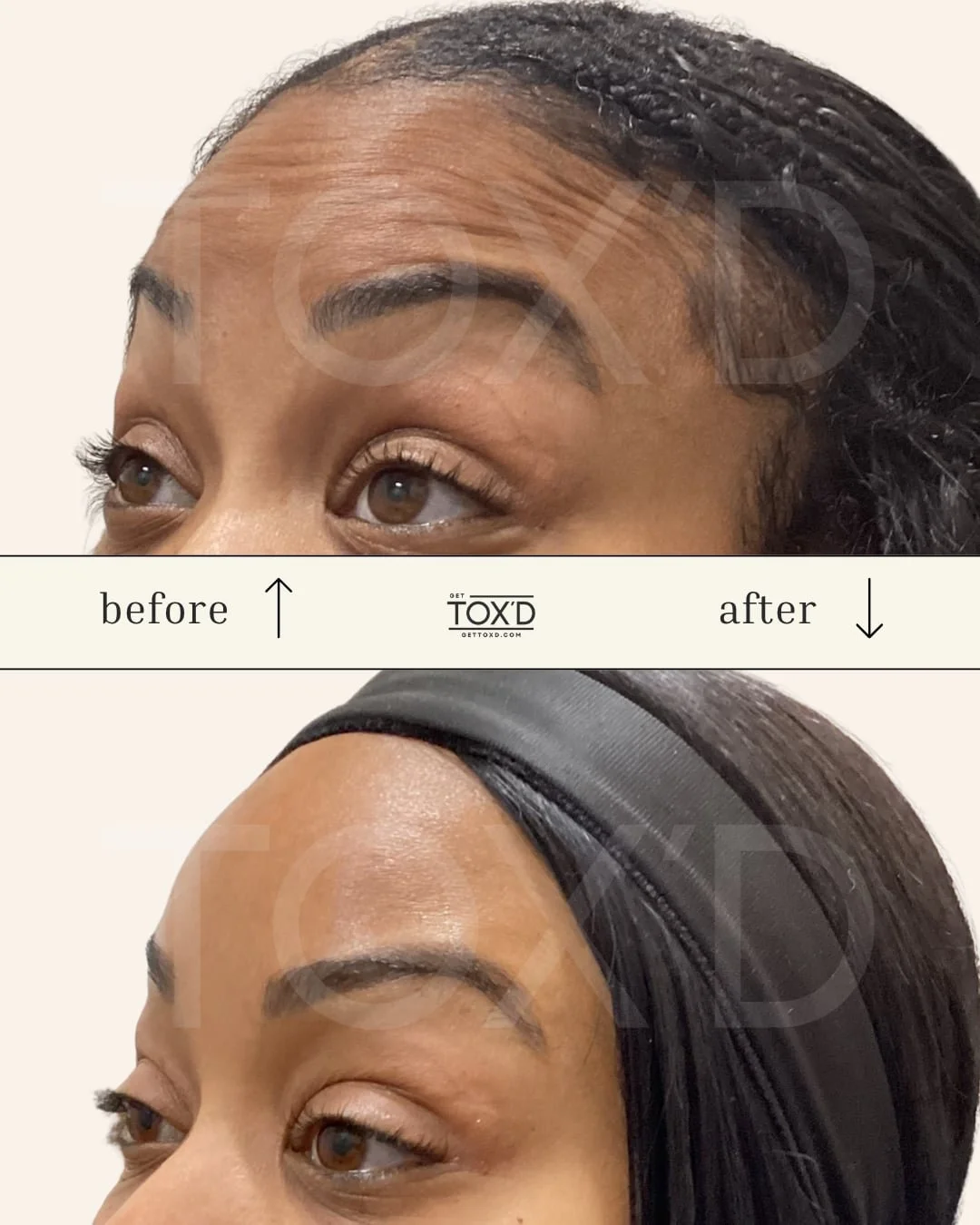 Get Tox’d client showing botox results for forehead area