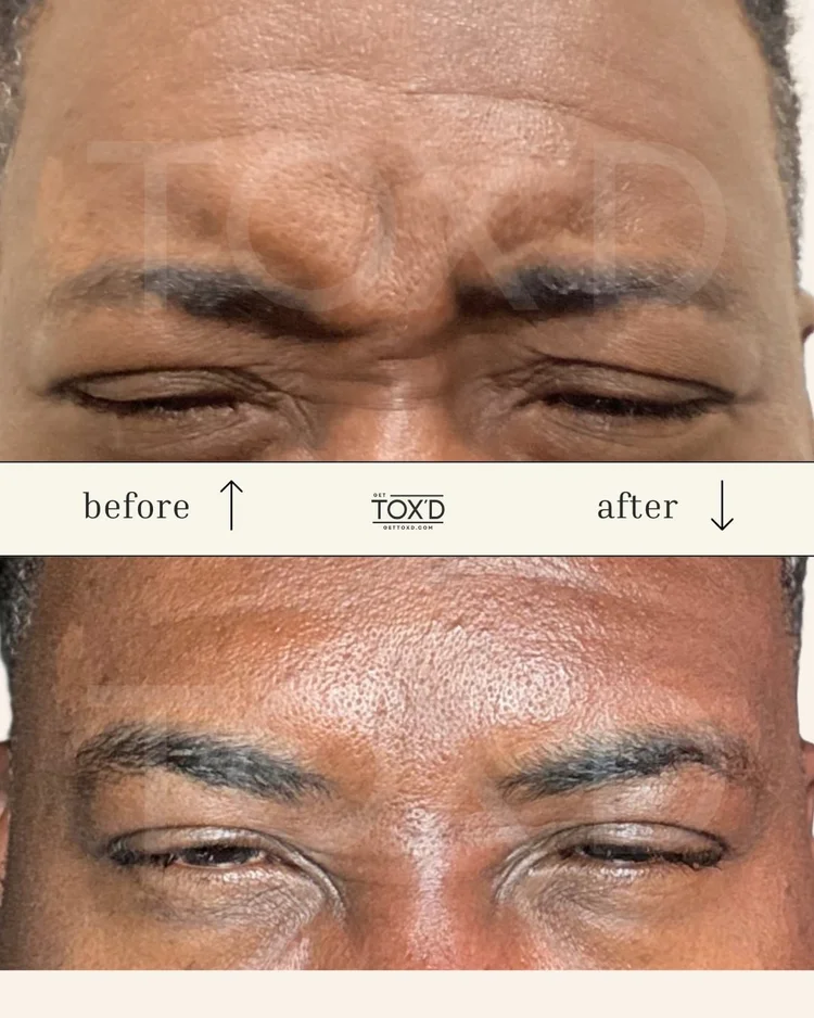 Frown lines (11s) before and after Botox at Get Tox'd