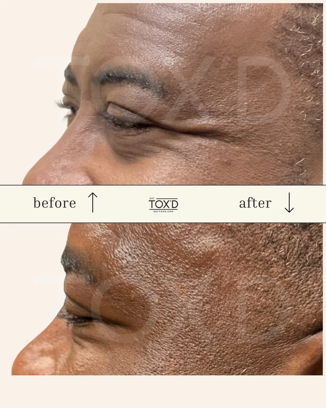 Crow’s feet botox results, before and after photos from Tox’d
