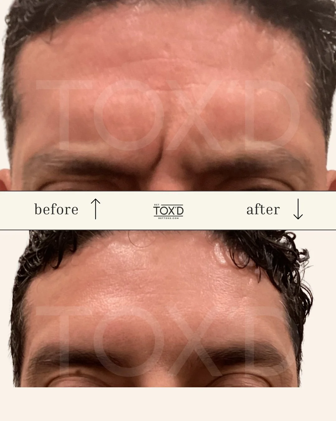 Tox’d botox results: smoother crow’s feet in real client photo