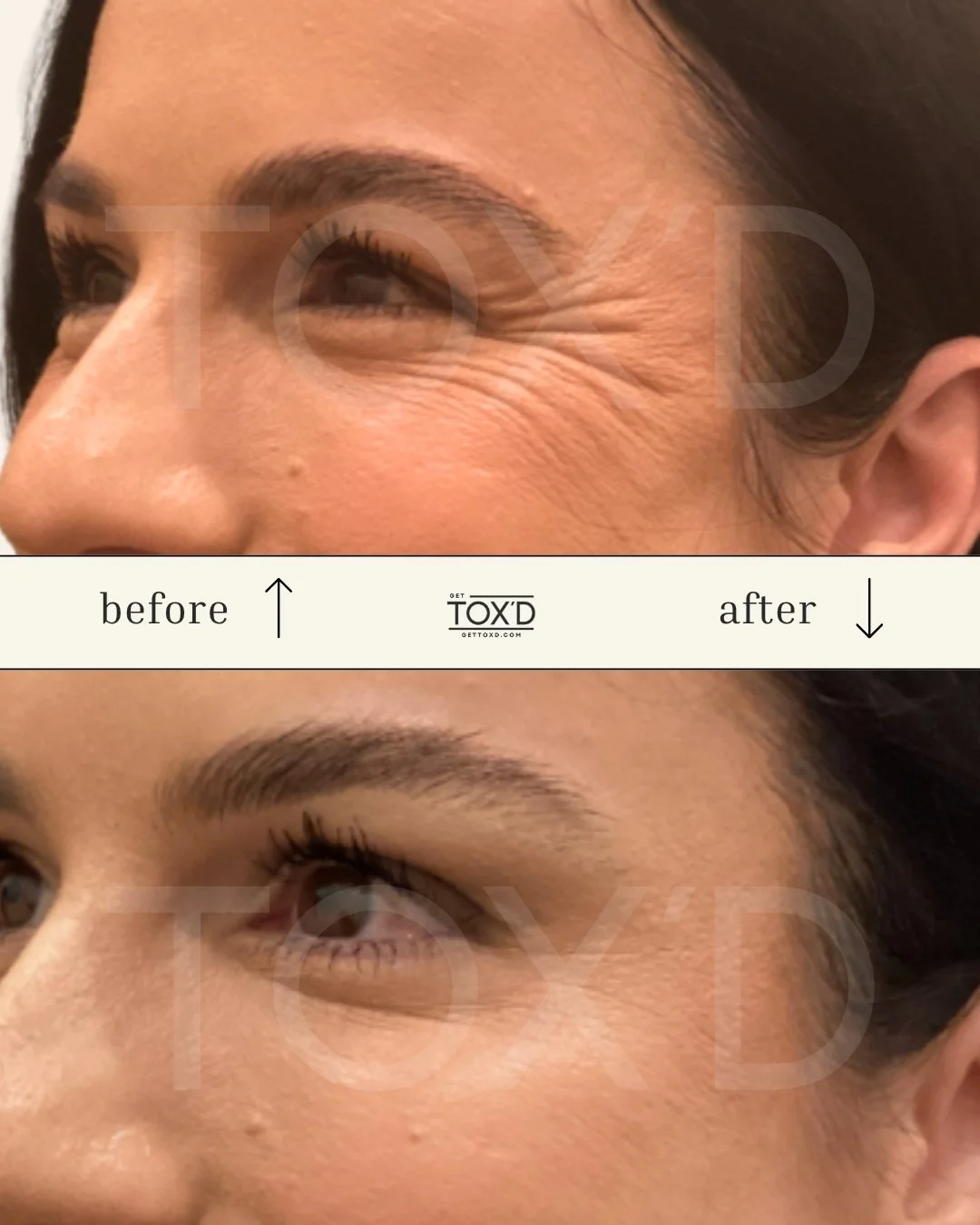 Real results of botox for crow’s feet at Tox’d