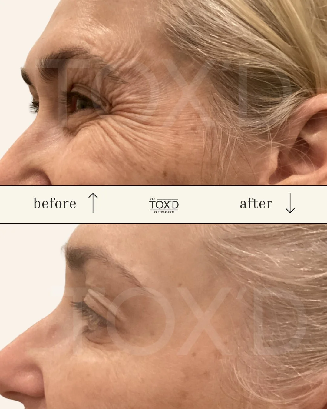 Botox real results crow’s feet transformation at Tox’d