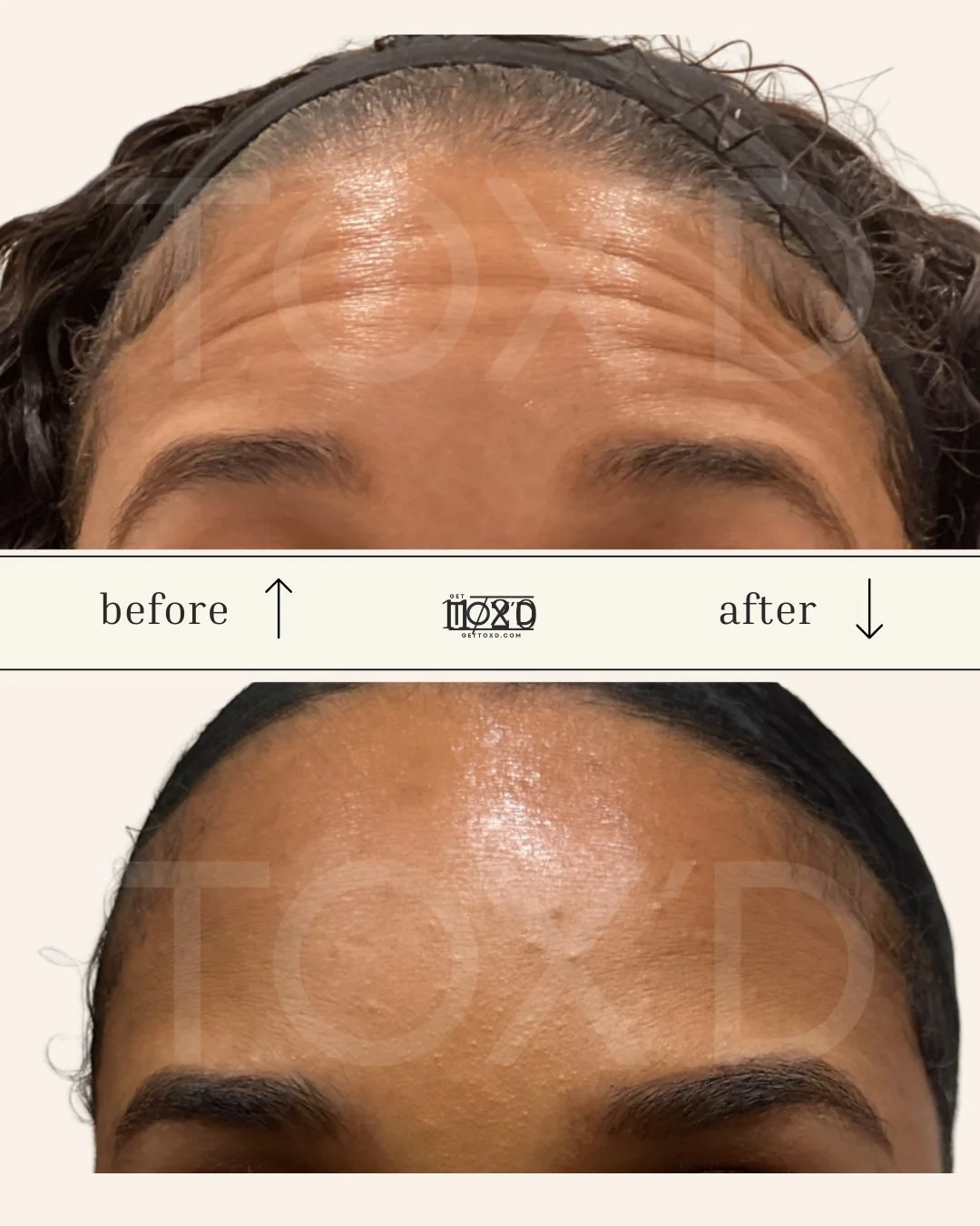 Botox real results forehead transformation at Tox’d