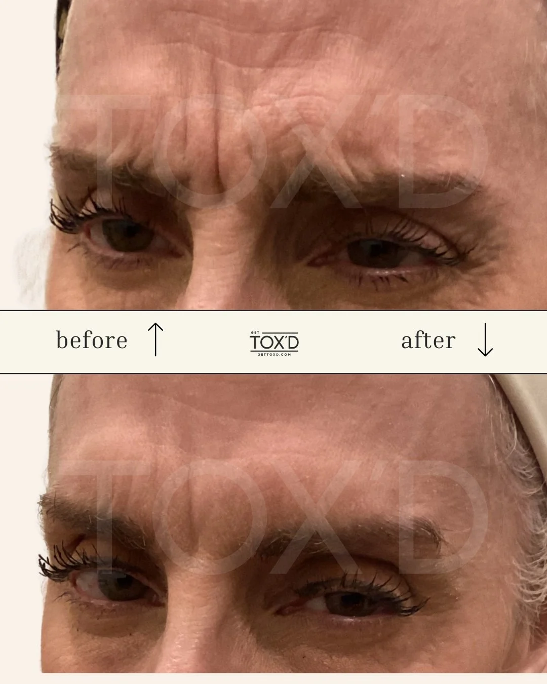 Frown lines botox results, before and after photos from Tox’d