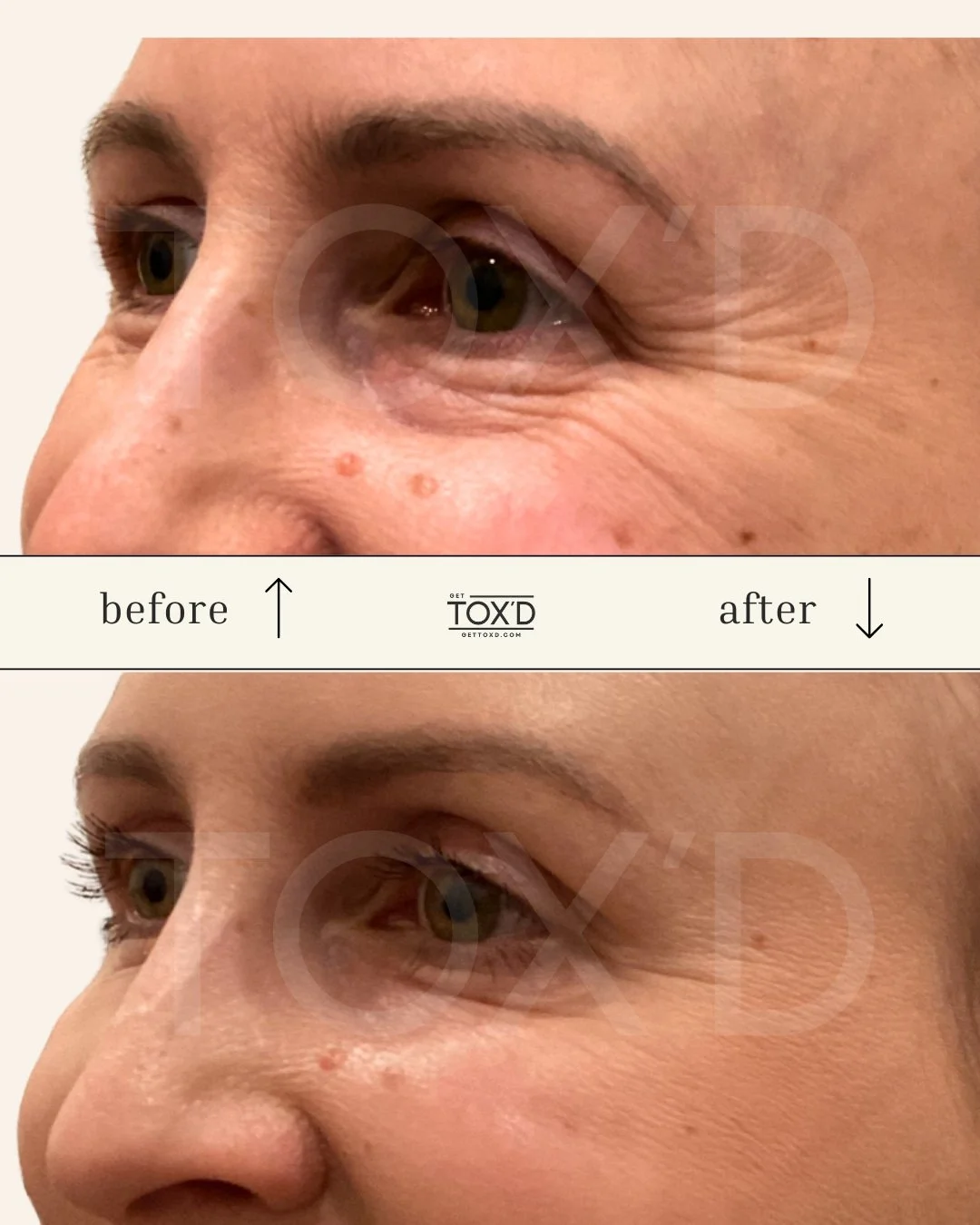 Real botox results: crow’s feet reduction at Tox’d