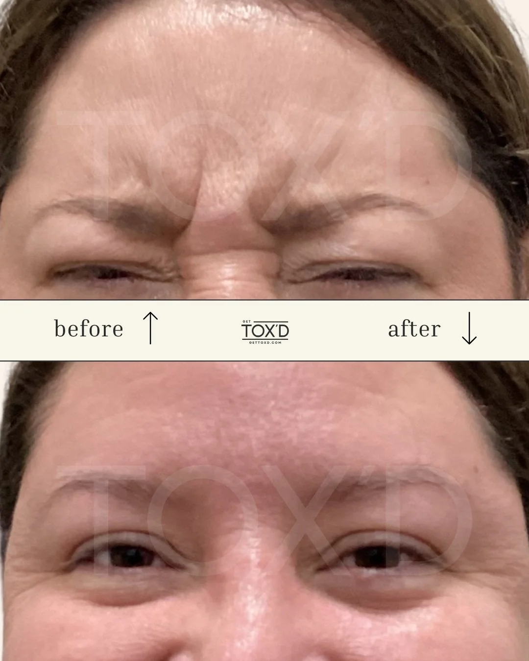 Botox real results: frown lines before and after at Tox’d