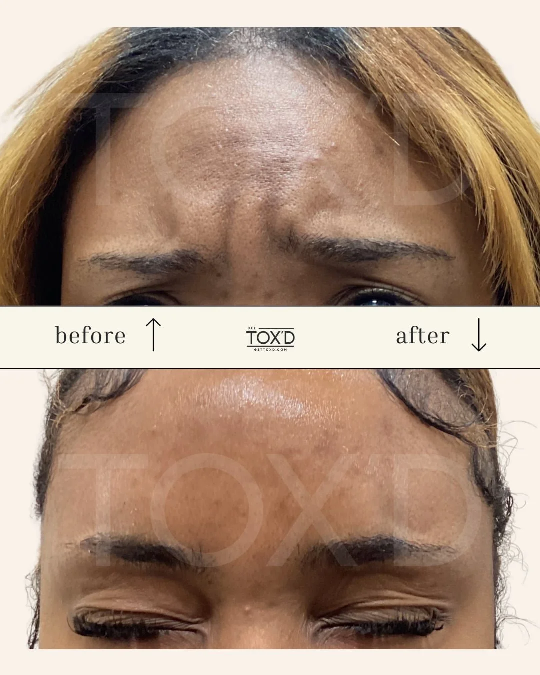 Botox real results on crow’s feet, Tox’d Medical Spa client