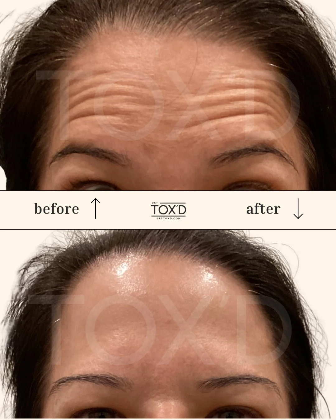 Botox real results: forehead before and after at Tox’d